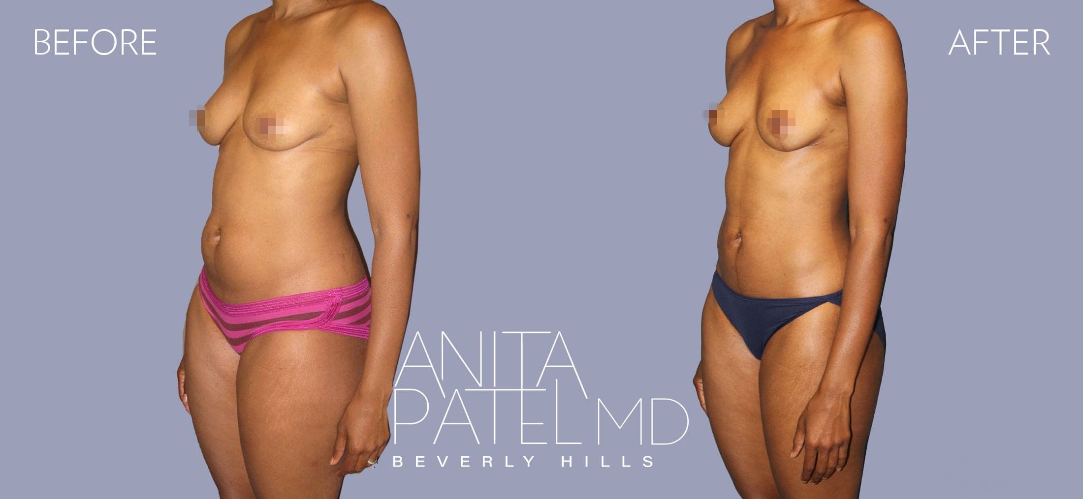 Liposuction before and after — Patient 8, photo 4 of 6 — Dr. Anita Patel, MD, FACS, Beverly Hills