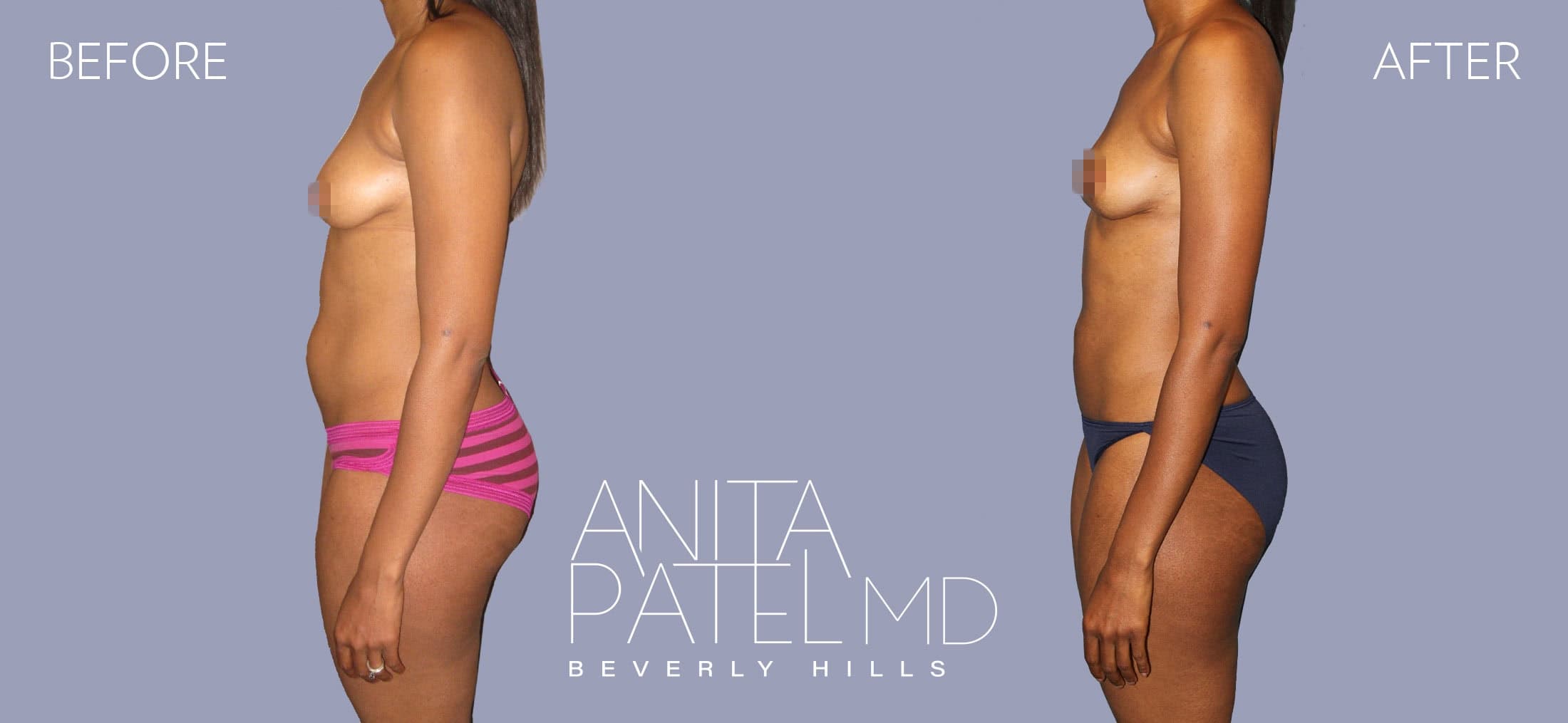 Liposuction before and after — Patient 8, photo 5 of 6 — Dr. Anita Patel, MD, FACS, Beverly Hills