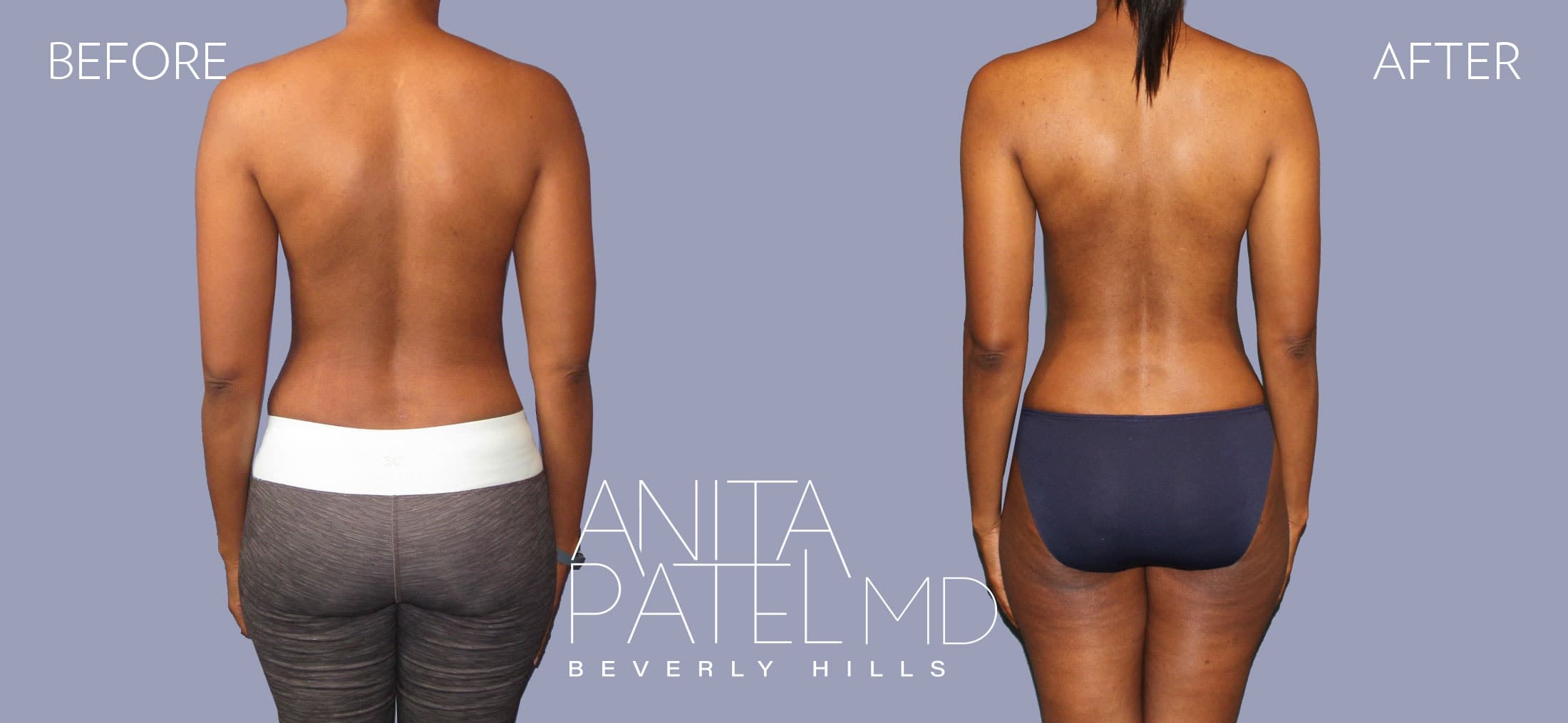 Liposuction before and after — Patient 8, photo 6 of 6 — Dr. Anita Patel, MD, FACS, Beverly Hills