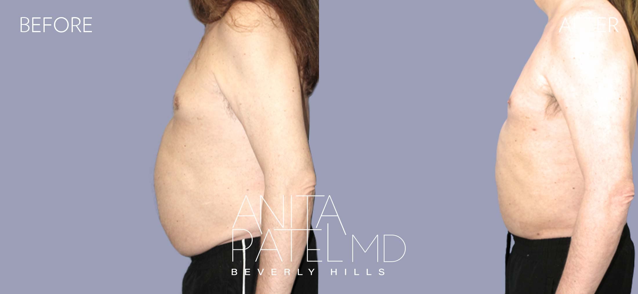 Liposuction before and after — Patient 9, photo 1 of 2 — Dr. Anita Patel, MD, FACS, Beverly Hills