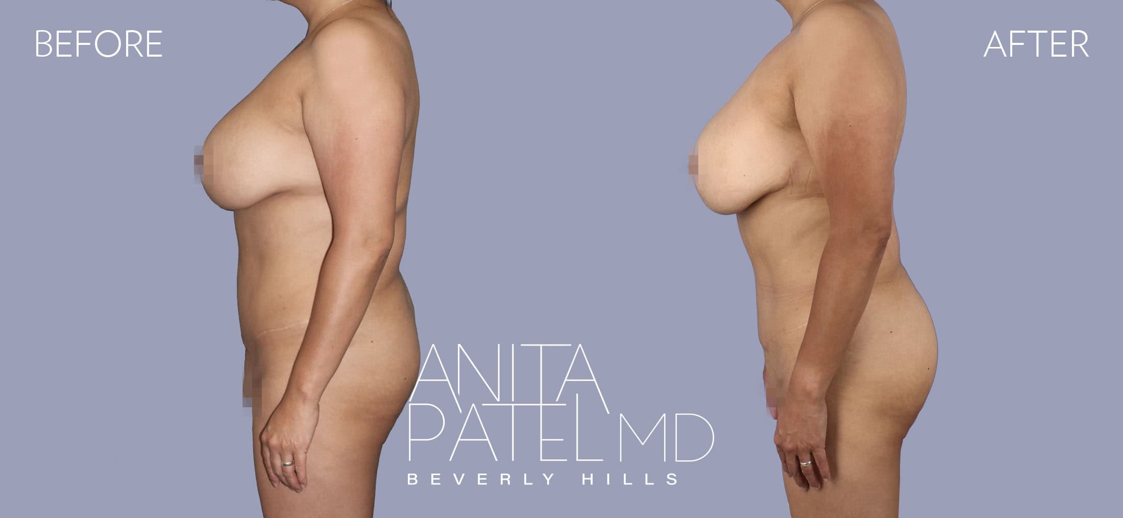 Liposuction before and after — Patient 10, photo 1 of 2 — Dr. Anita Patel, MD, FACS, Beverly Hills