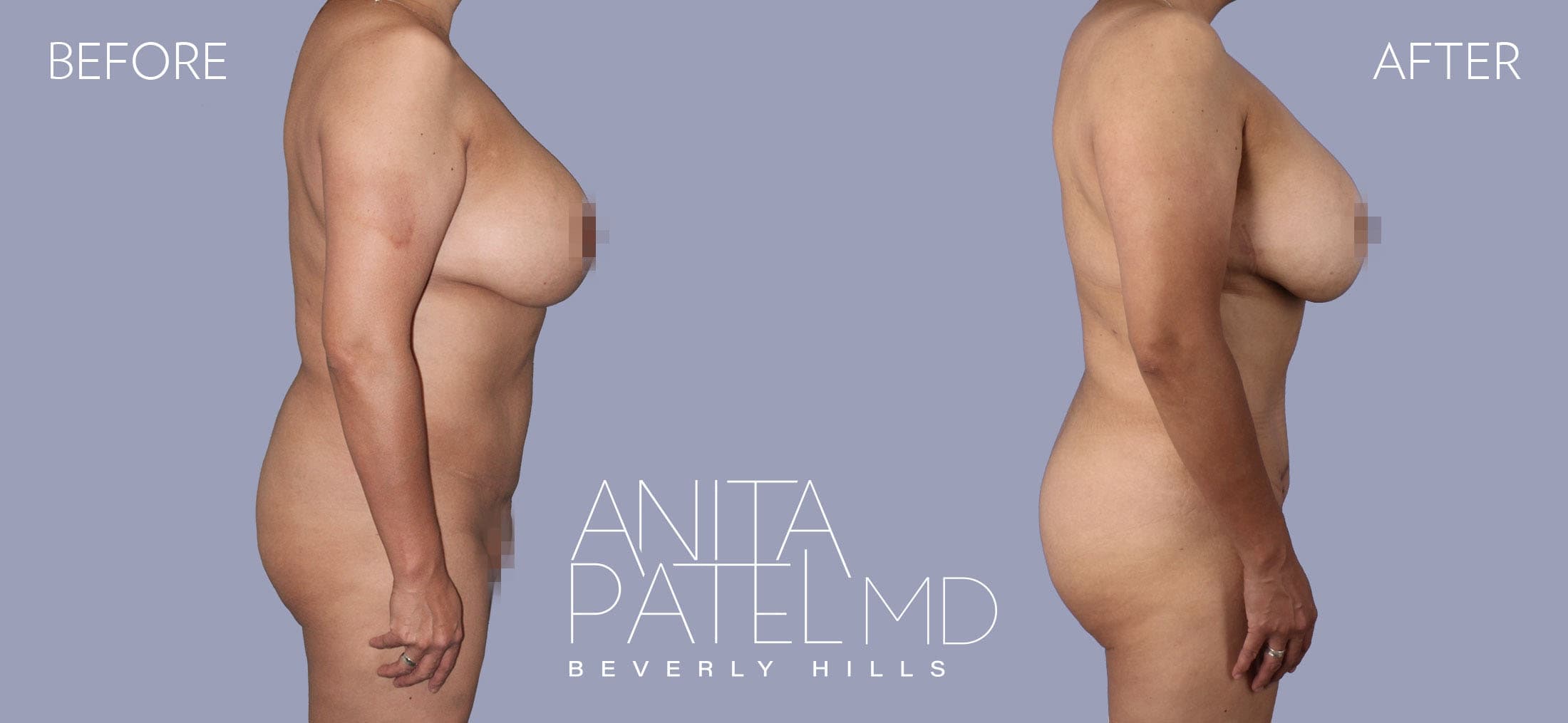Liposuction before and after — Patient 10, photo 2 of 2 — Dr. Anita Patel, MD, FACS, Beverly Hills