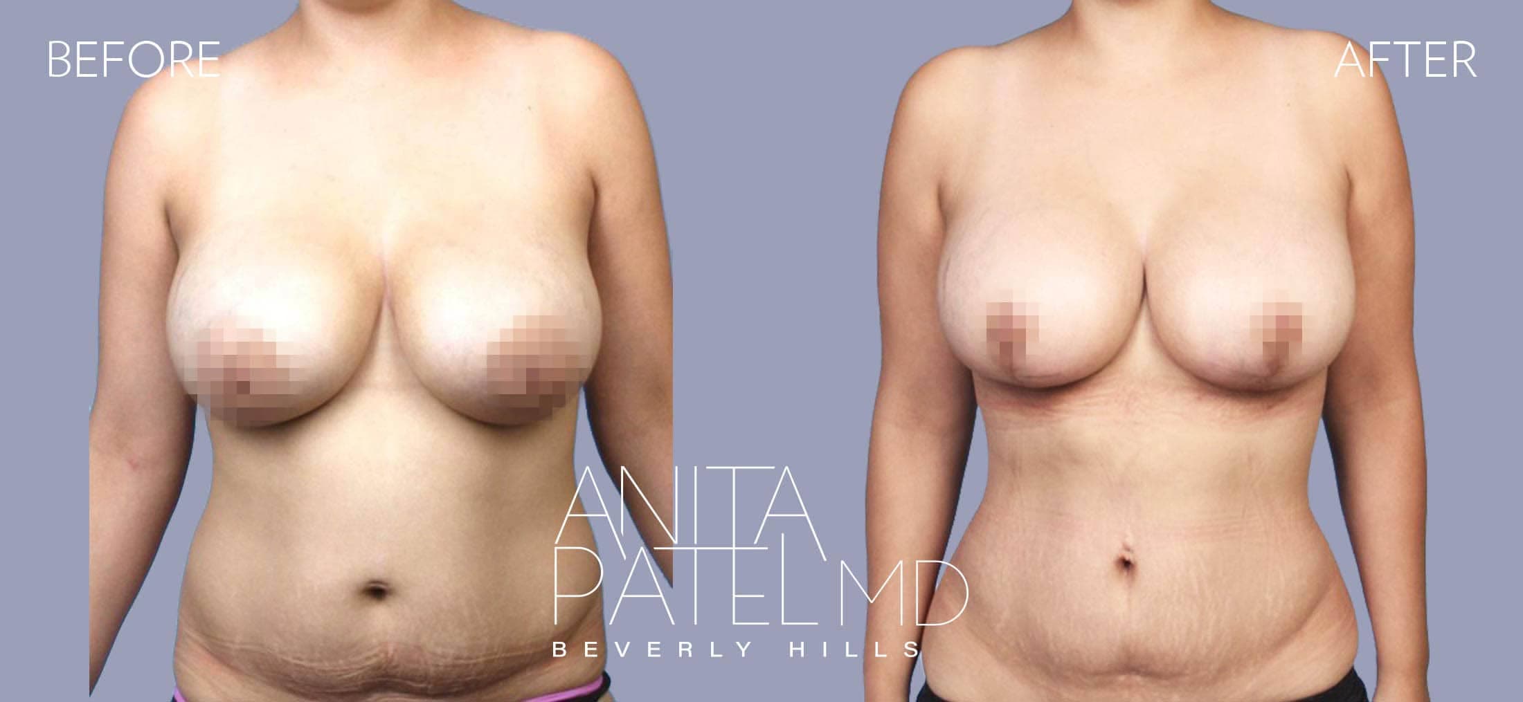 Liposuction before and after — Patient 3, photo 1 of 5 — Dr. Anita Patel, MD, FACS, Beverly Hills