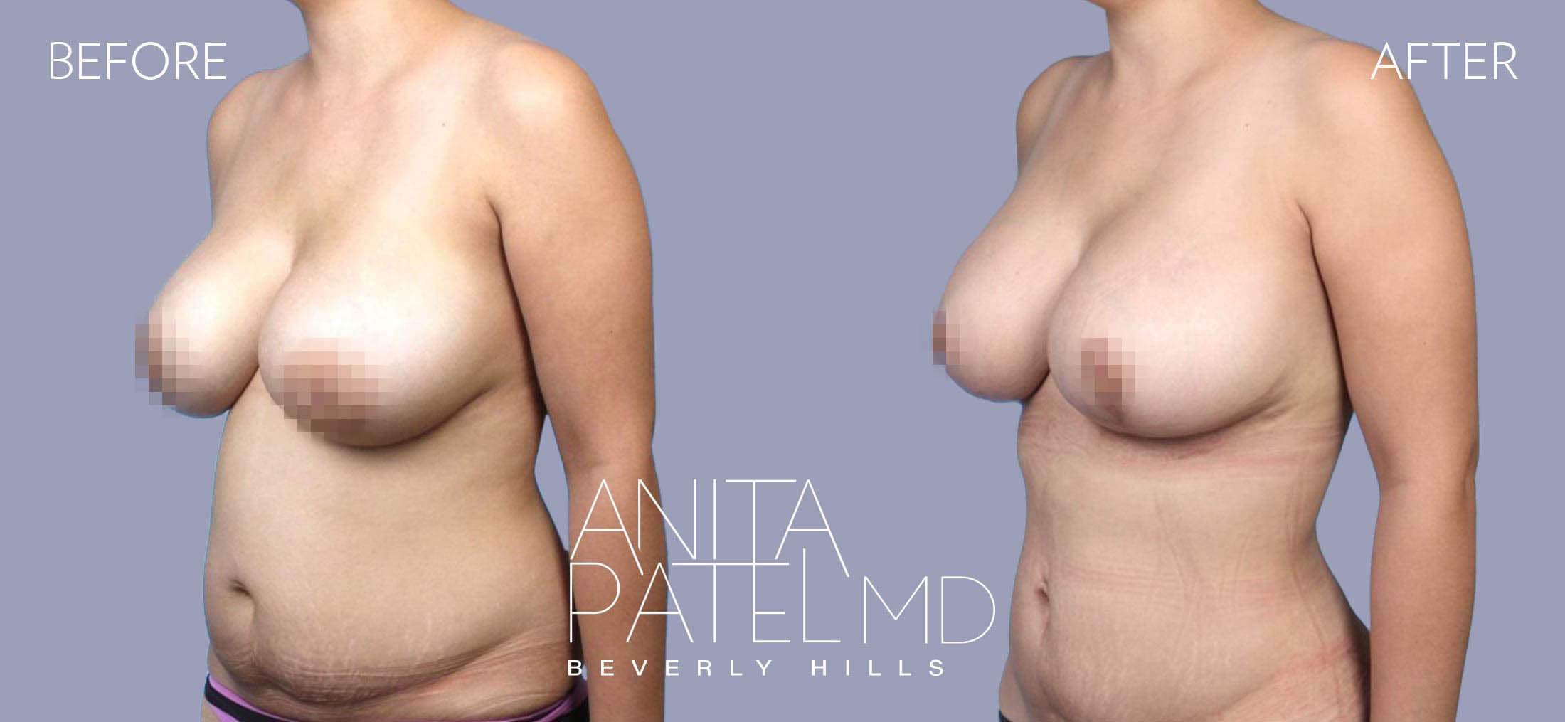 Liposuction before and after — Patient 3, photo 2 of 5 — Dr. Anita Patel, MD, FACS, Beverly Hills