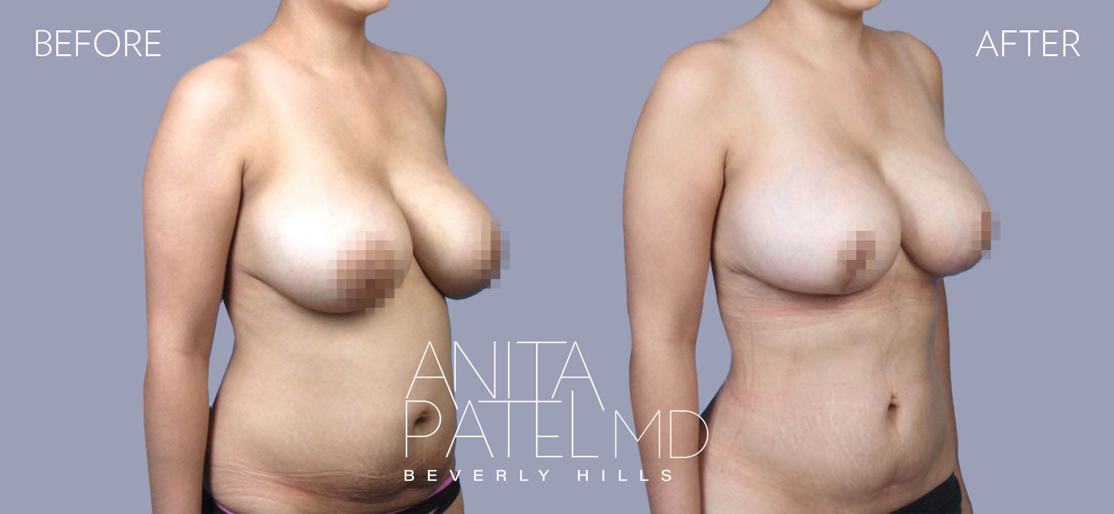 Liposuction before and after — Patient 3, photo 4 of 5 — Dr. Anita Patel, MD, FACS, Beverly Hills