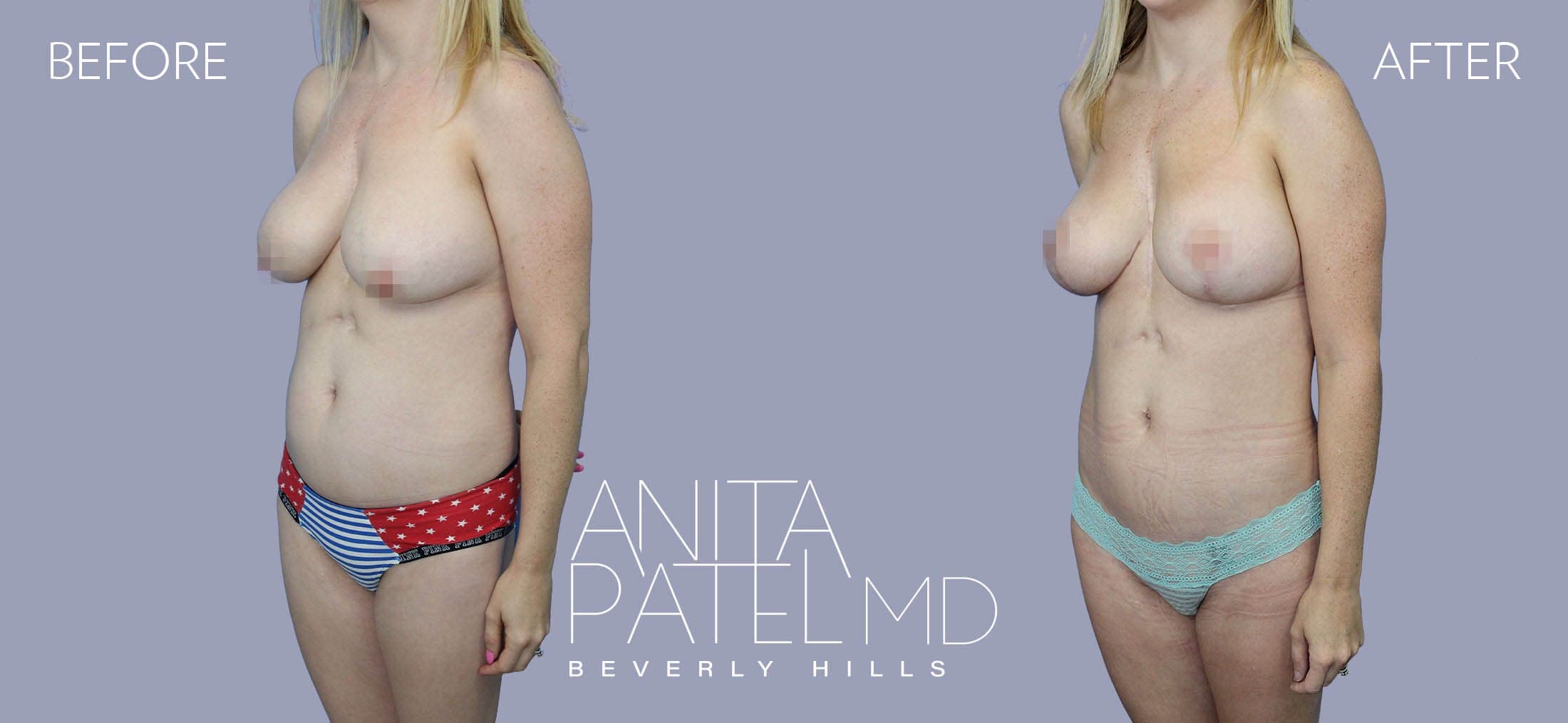 Liposuction before and after — Patient 8, photo 4 of 5 — Dr. Anita Patel, MD, FACS, Beverly Hills