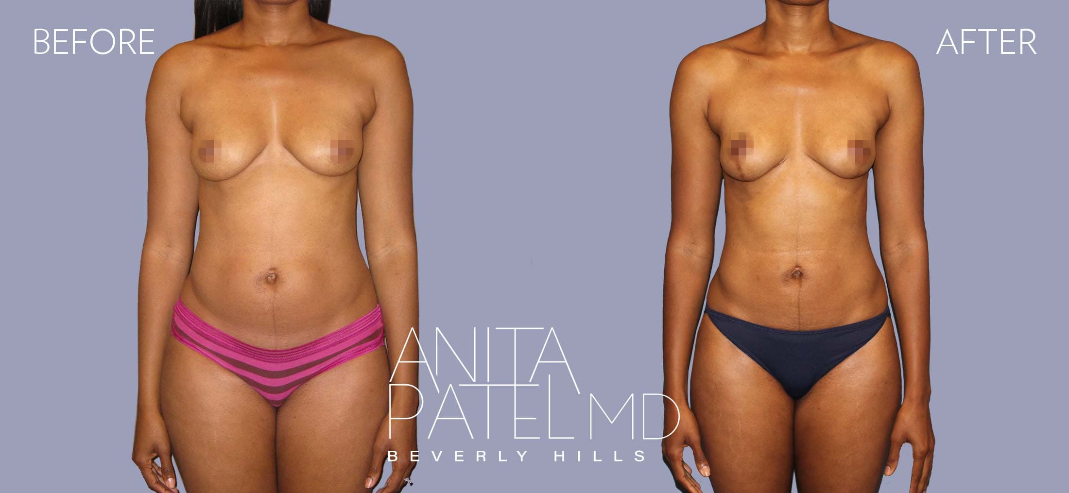 Liposuction before and after — Patient 5, photo 1 of 5 — Dr. Anita Patel, MD, FACS, Beverly Hills