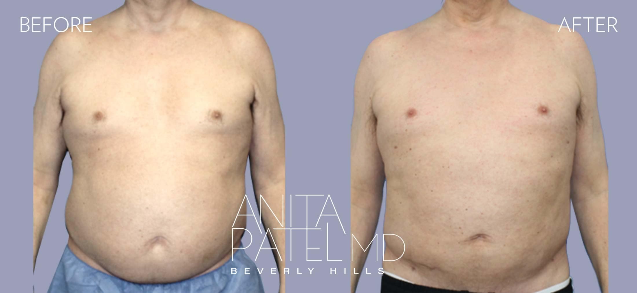 Liposuction before and after — Patient 11, photo 2 of 2 — Dr. Anita Patel, MD, FACS, Beverly Hills
