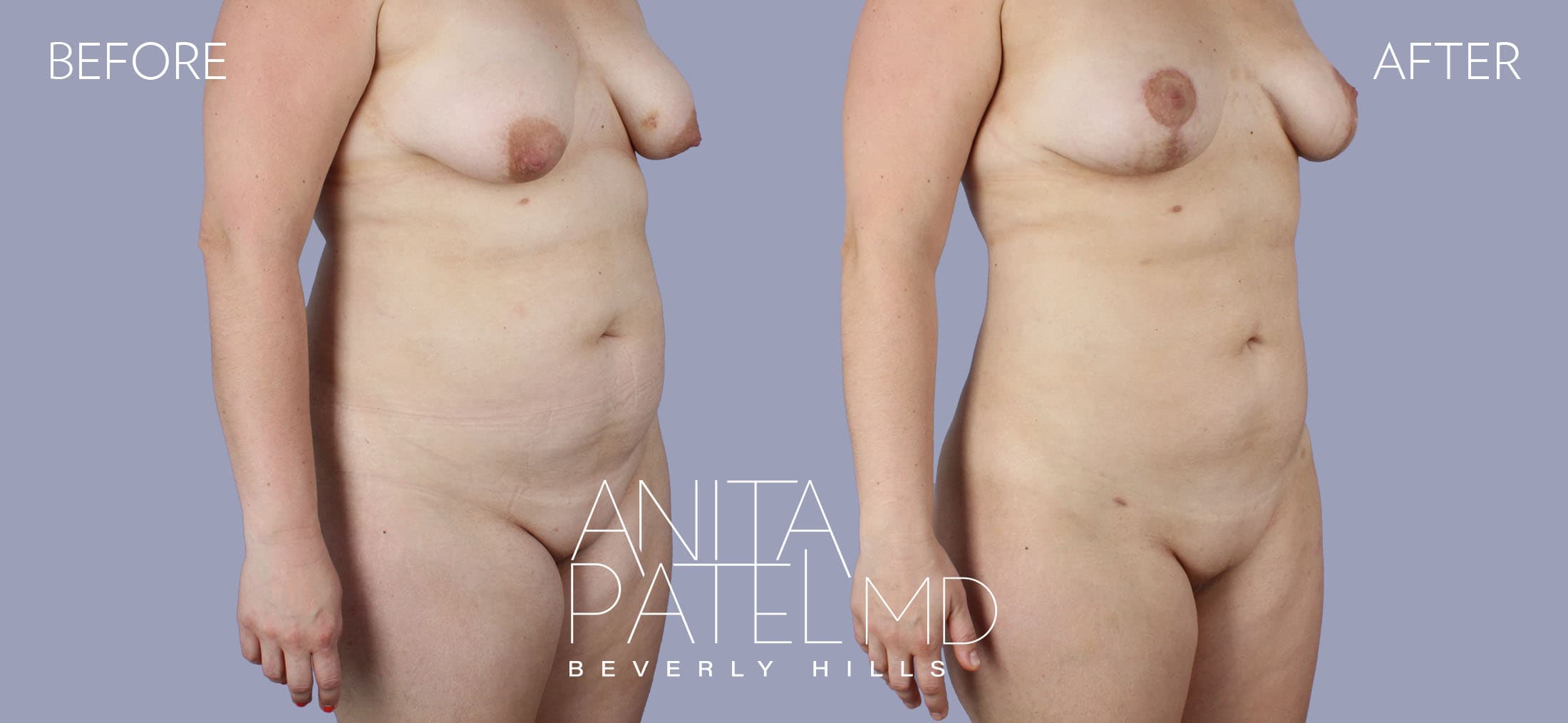 Liposuction before and after — Patient 1, photo 1 of 5 — Dr. Anita Patel, MD, FACS, Beverly Hills