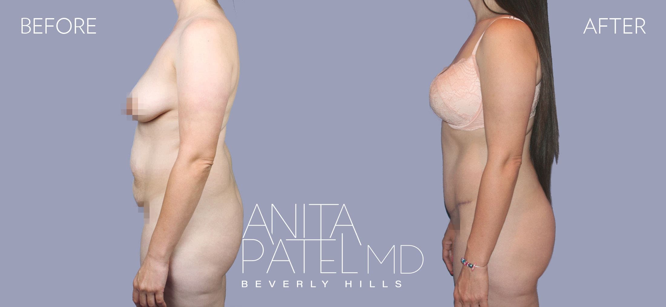 Liposuction before and after — Patient 9, photo 2 of 3 — Dr. Anita Patel, MD, FACS, Beverly Hills