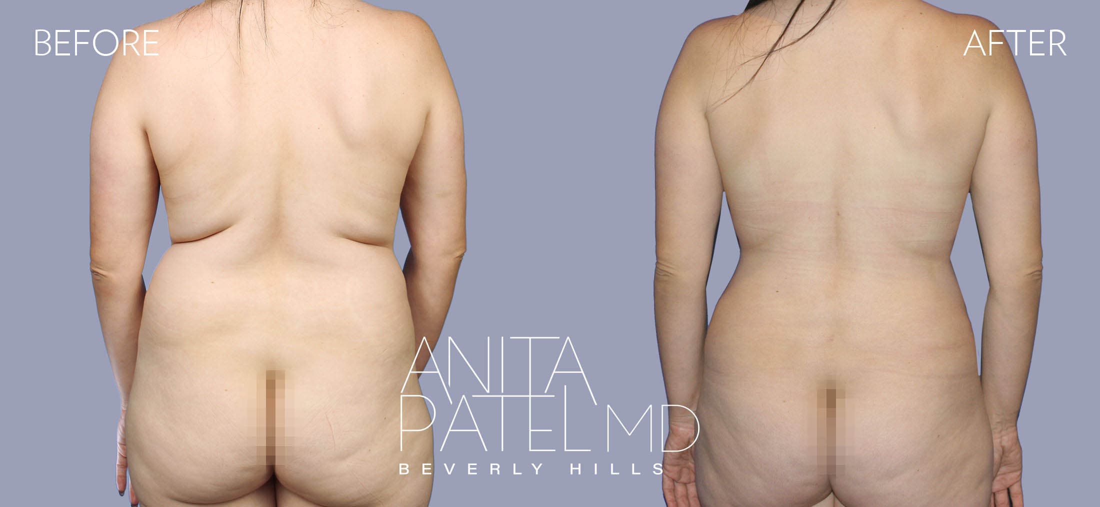 Liposuction before and after — Patient 9, photo 1 of 3 — Dr. Anita Patel, MD, FACS, Beverly Hills