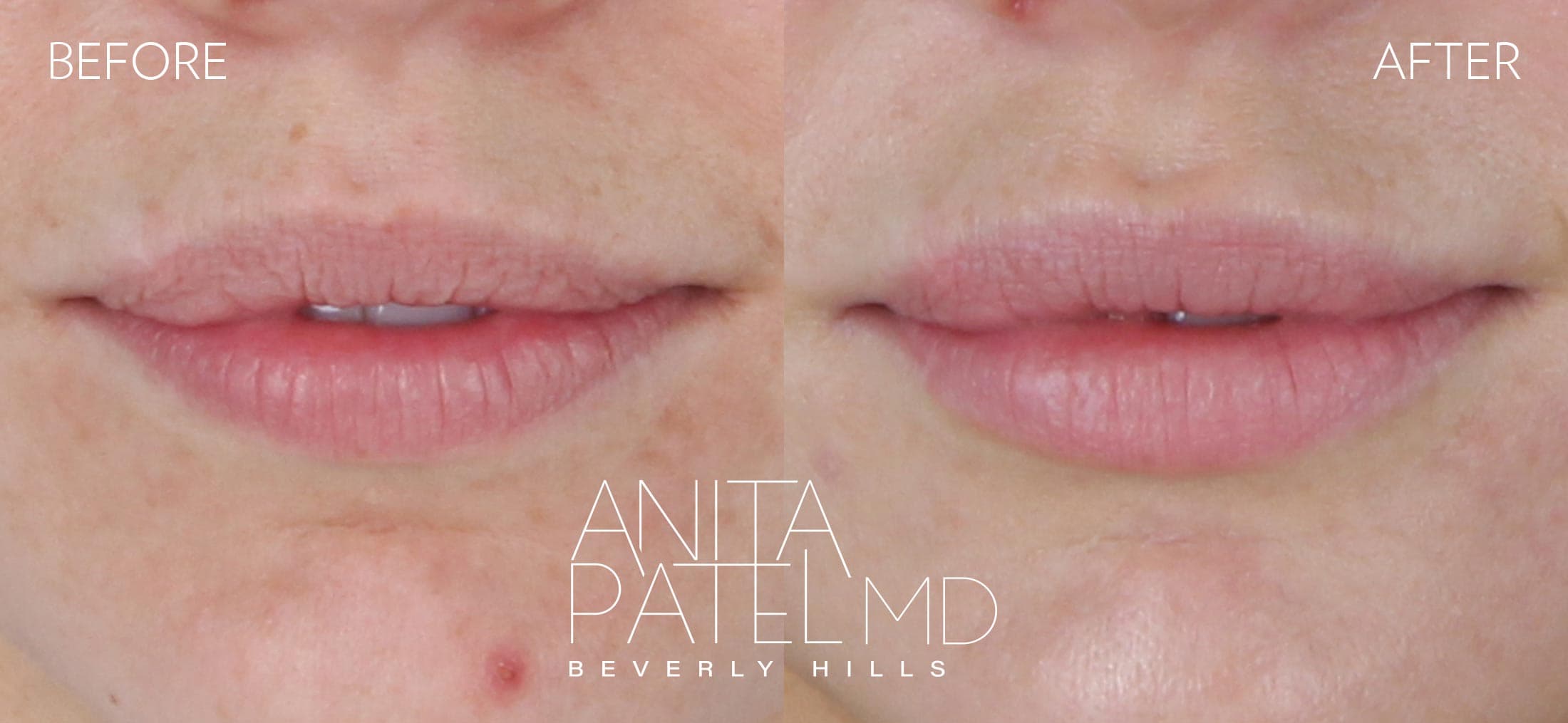 Lip Fillers before and after — Patient 21 — Dr. Anita Patel, MD, FACS, Beverly Hills