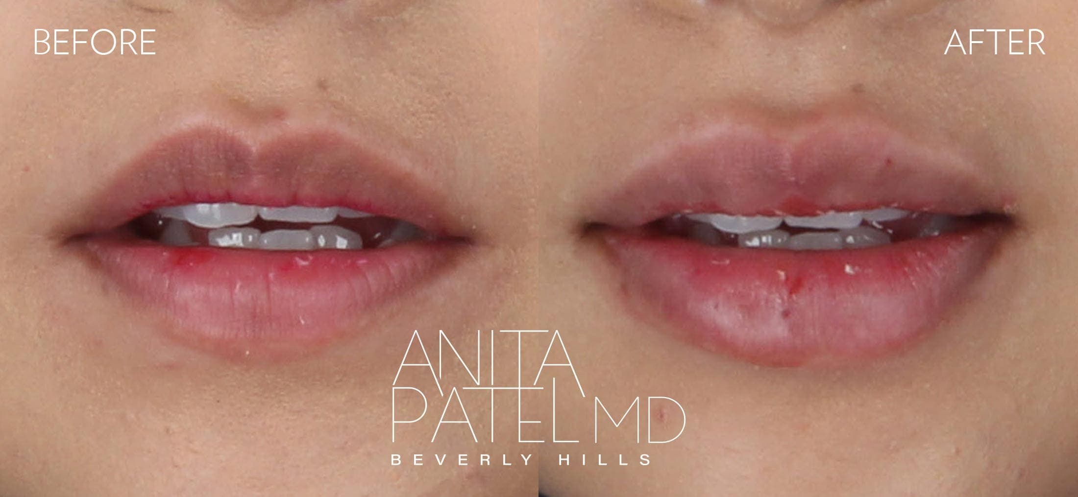 Lip Fillers before and after — Patient 23, photo 1 of 2 — Dr. Anita Patel, MD, FACS, Beverly Hills