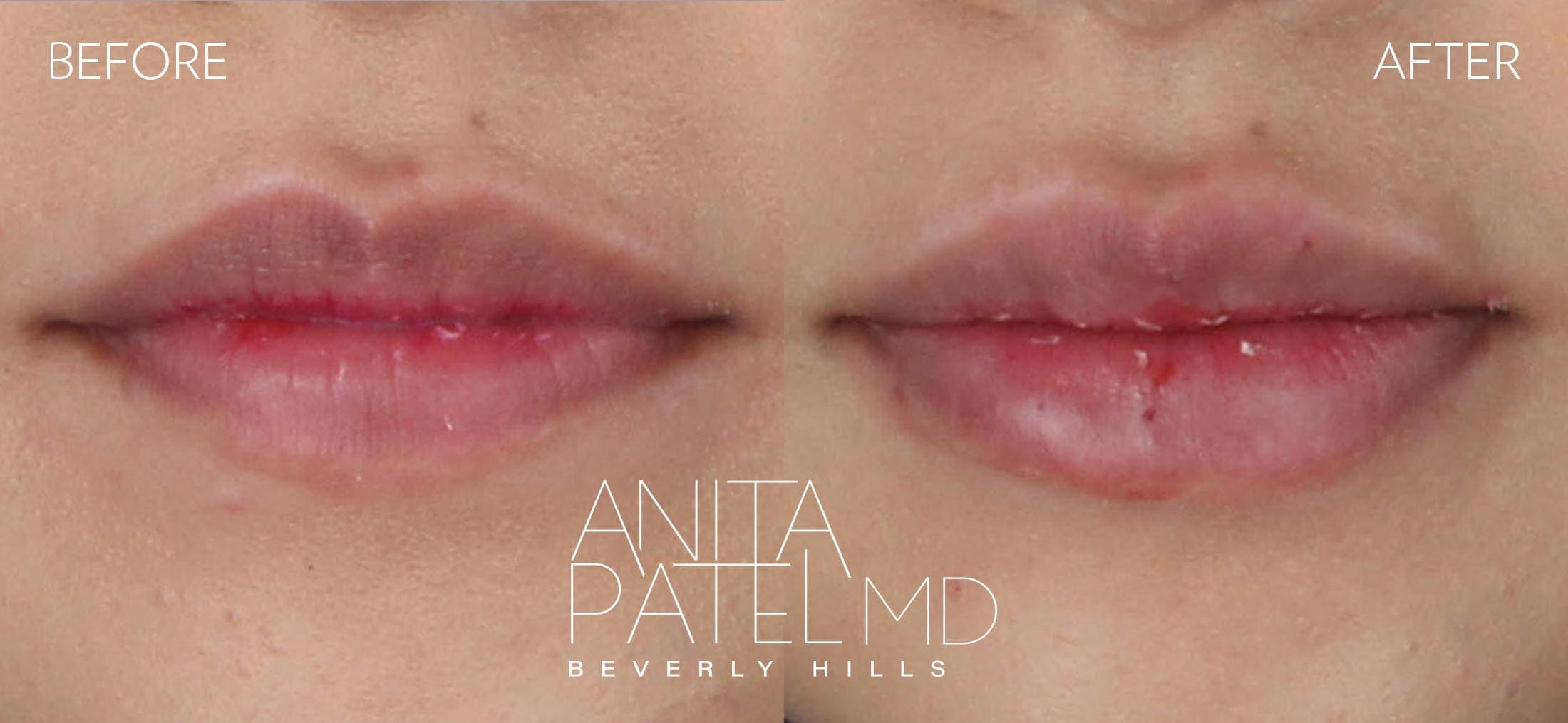 Lip Fillers before and after — Patient 23, photo 2 of 2 — Dr. Anita Patel, MD, FACS, Beverly Hills