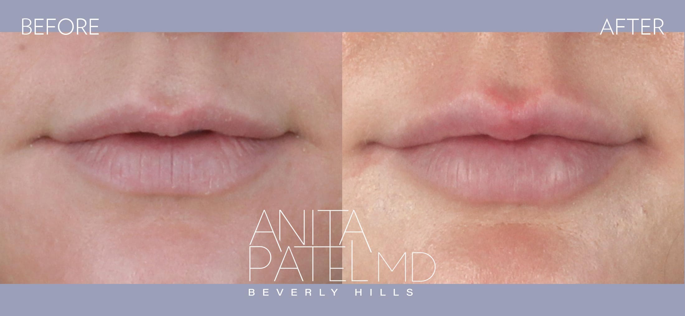 Lip Fillers before and after — Dr. Anita Patel, Beverly Hills