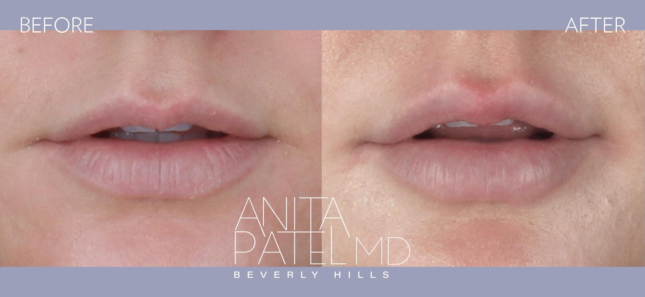 Lip Fillers before and after — Patient 1, photo 2 of 2 — Dr. Anita Patel, MD, FACS, Beverly Hills