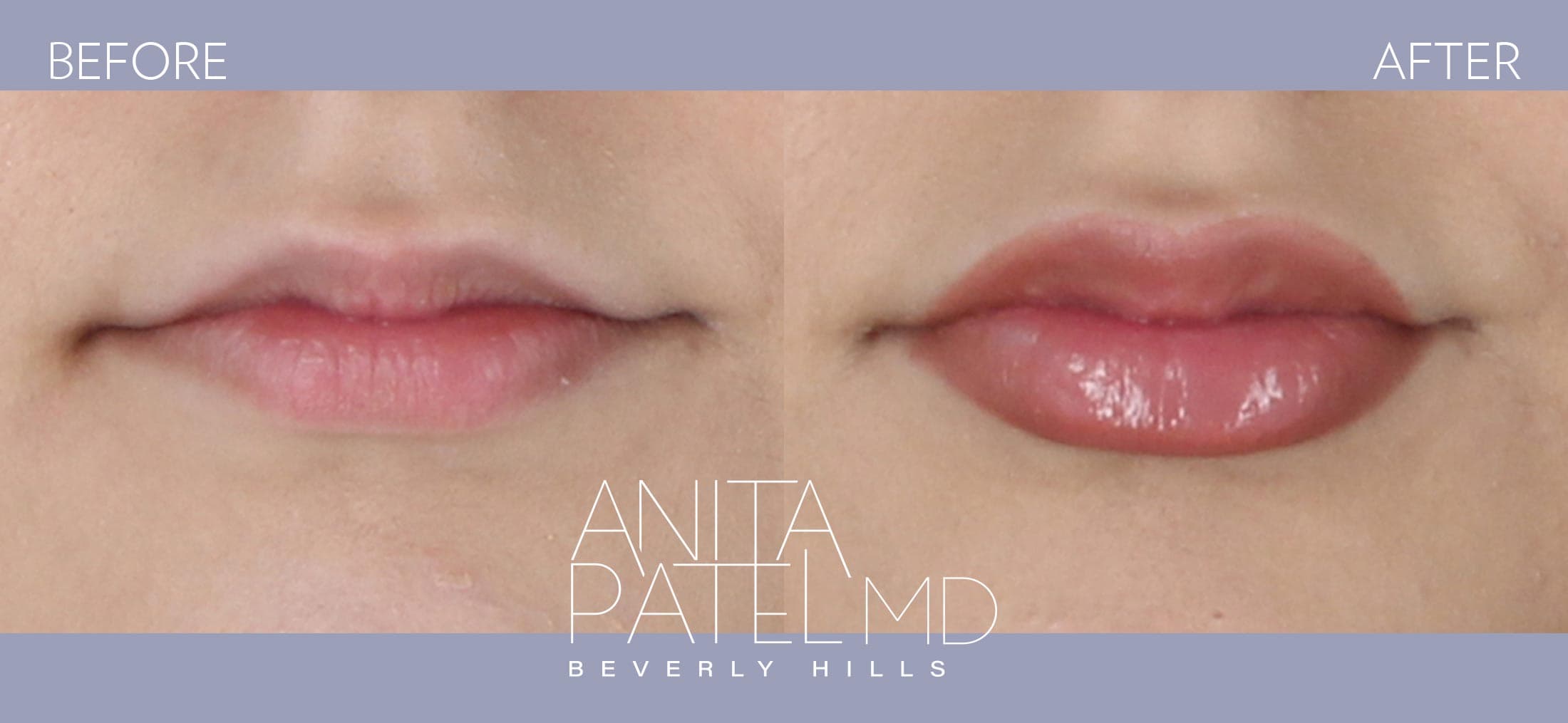 Lip Fillers before and after — Patient 10 — Dr. Anita Patel, MD, FACS, Beverly Hills