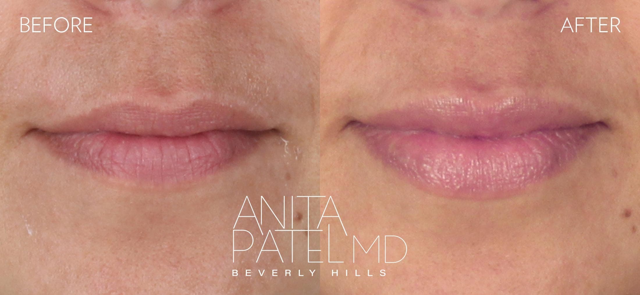 Lip Fillers before and after — Patient 24 — Dr. Anita Patel, MD, FACS, Beverly Hills