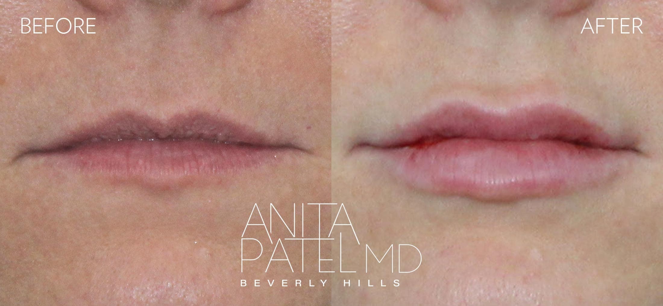 Lip Fillers before and after — Patient 25, photo 1 of 2 — Dr. Anita Patel, MD, FACS, Beverly Hills