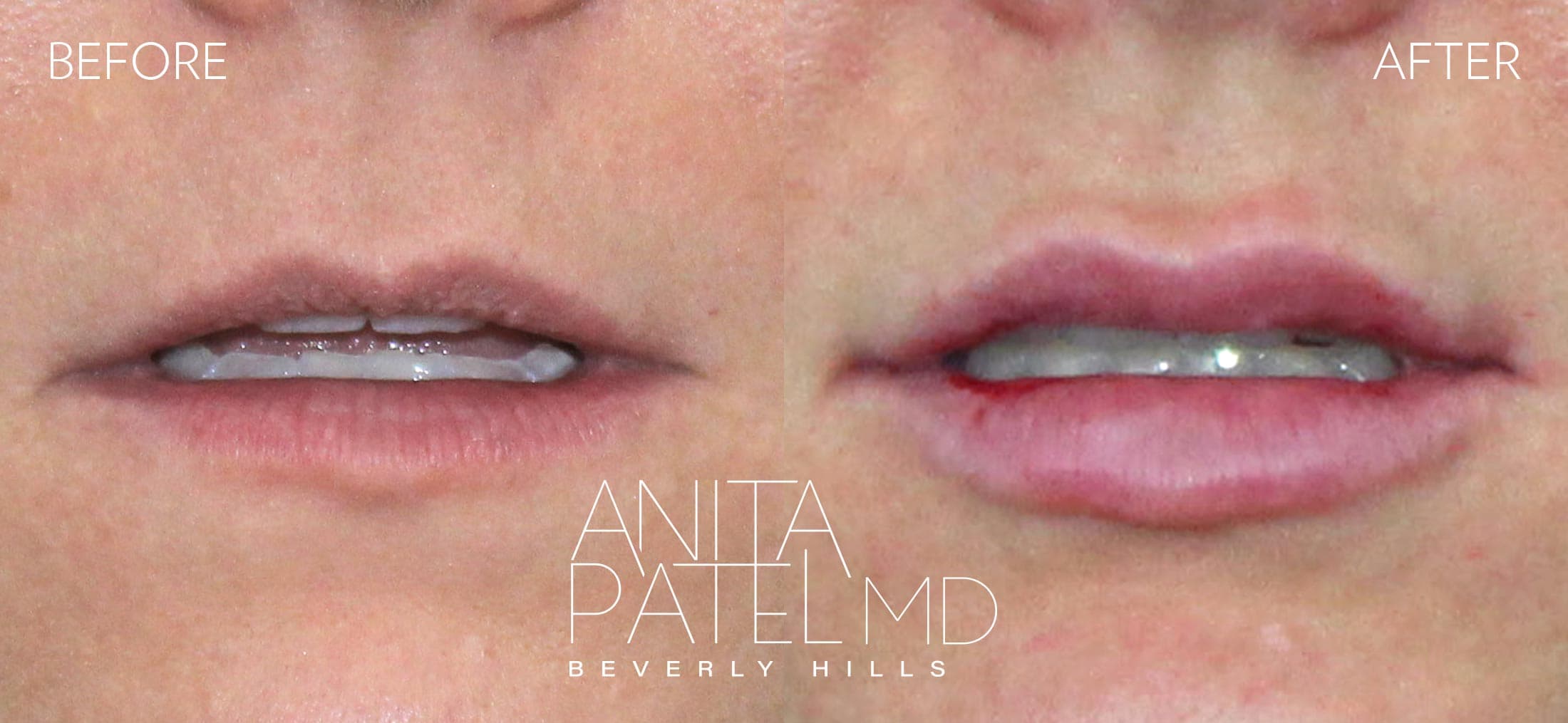Lip Fillers before and after — Patient 25, photo 2 of 2 — Dr. Anita Patel, MD, FACS, Beverly Hills