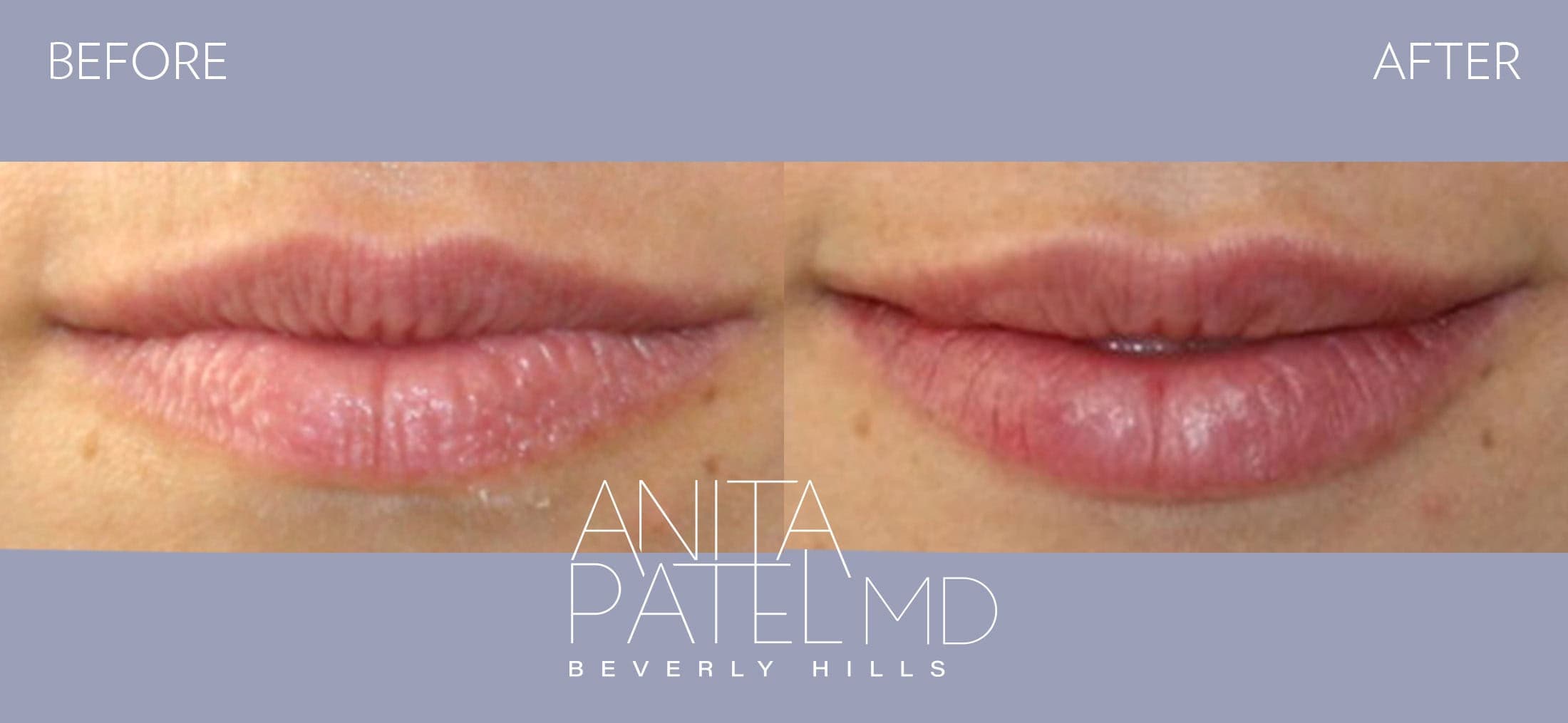 Lip Fillers before and after — Patient 26 — Dr. Anita Patel, MD, FACS, Beverly Hills