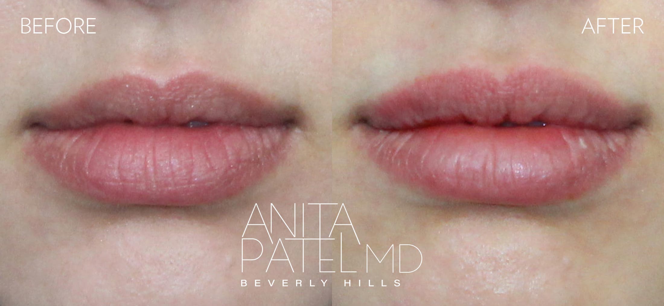 Lip Fillers before and after — Patient 29 — Dr. Anita Patel, MD, FACS, Beverly Hills