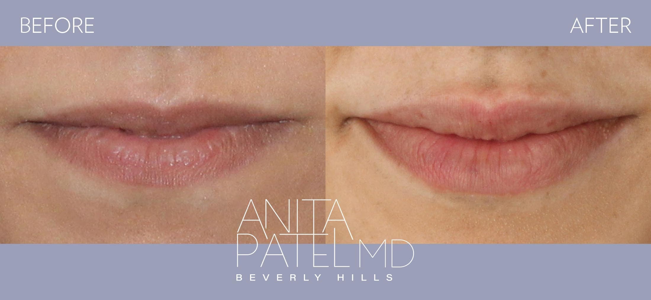 Lip Fillers before and after — Patient 30 — Dr. Anita Patel, MD, FACS, Beverly Hills