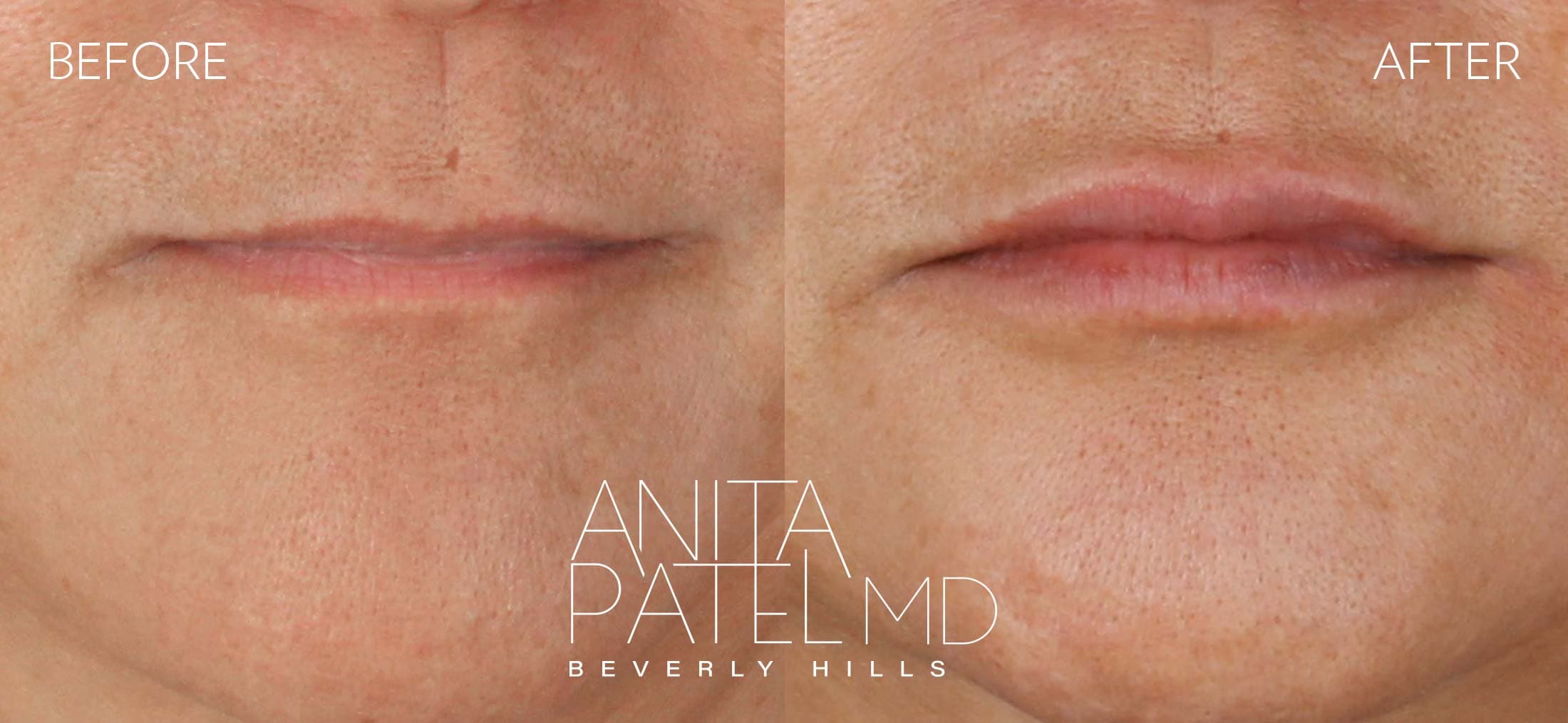 Lip Fillers before and after — Patient 31 — Dr. Anita Patel, MD, FACS, Beverly Hills