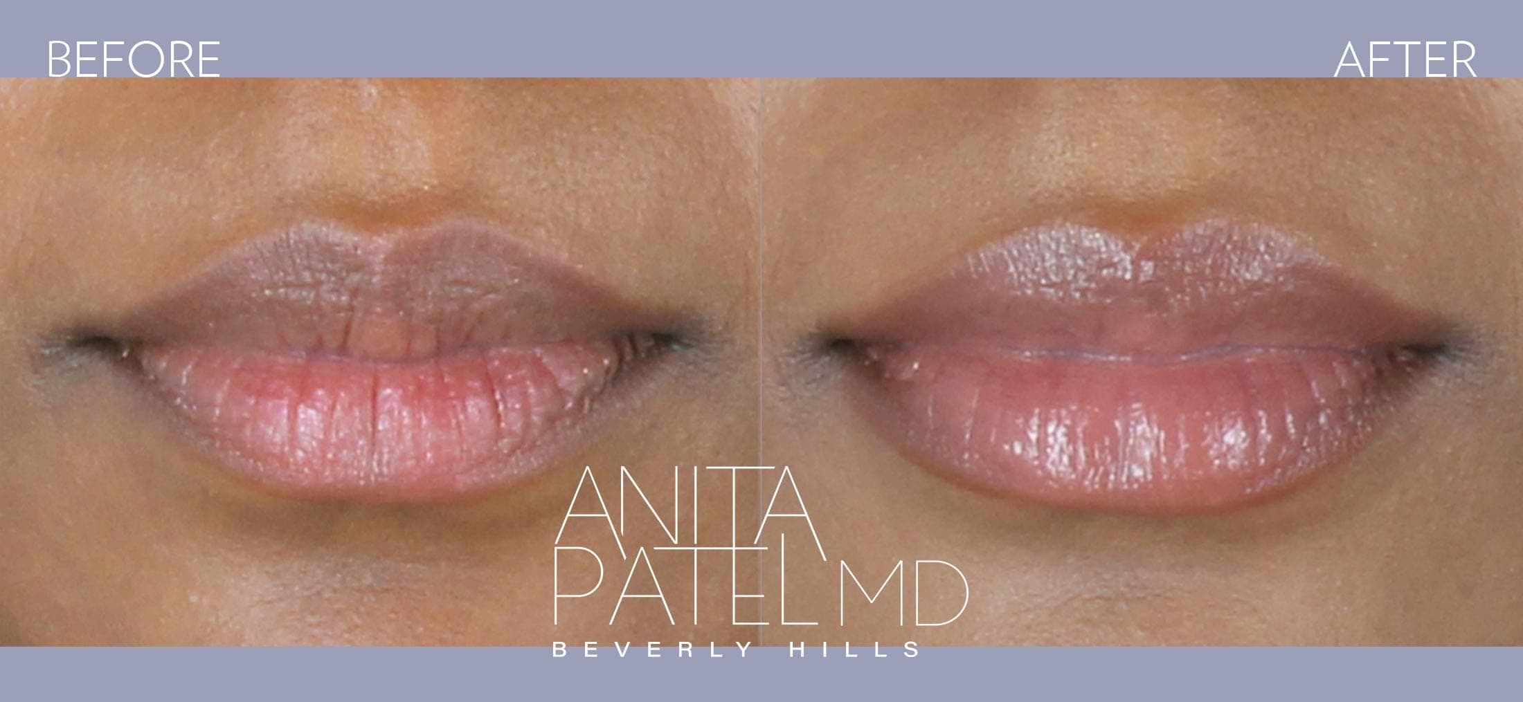 Lip Fillers before and after — Patient 3 — Dr. Anita Patel, MD, FACS, Beverly Hills