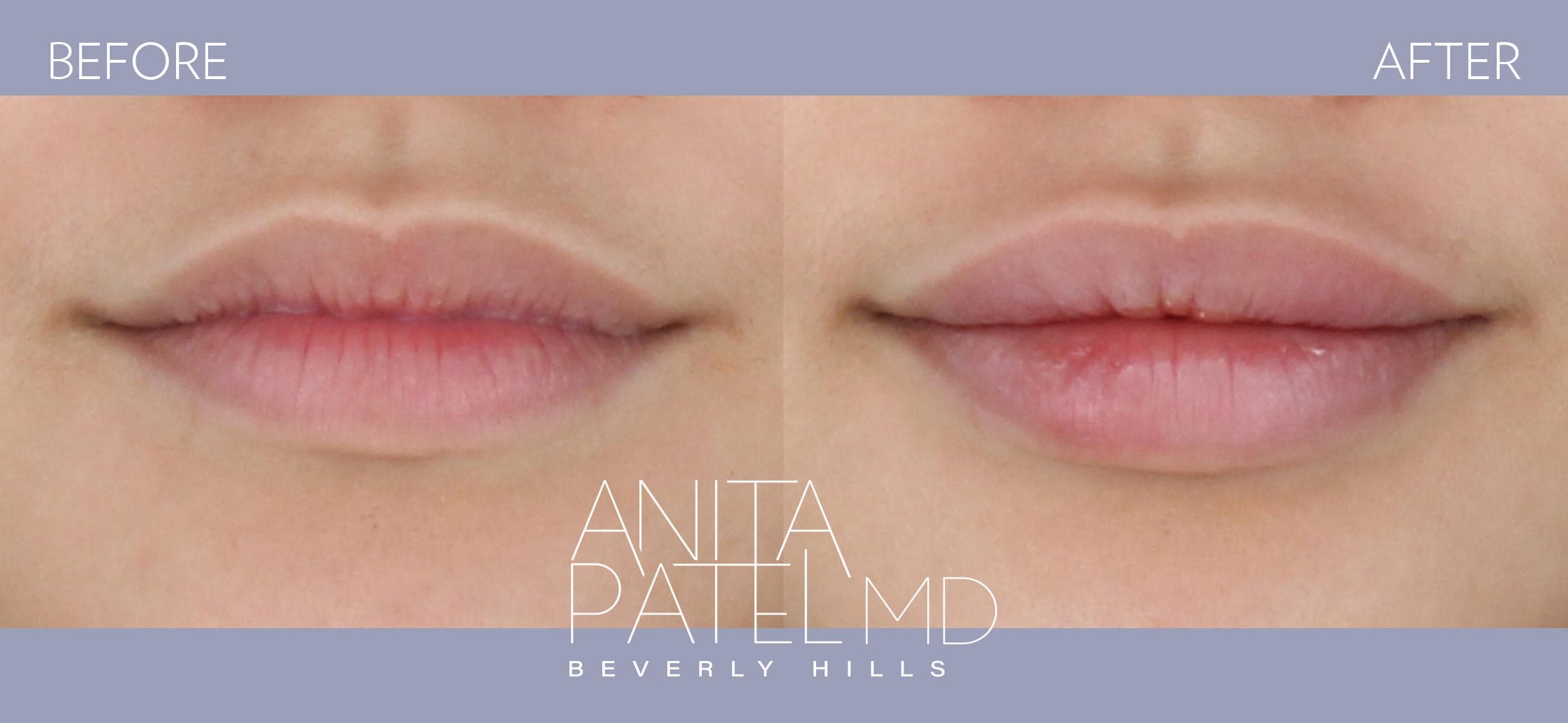 Lip Fillers before and after — Patient 4, photo 1 of 2 — Dr. Anita Patel, MD, FACS, Beverly Hills