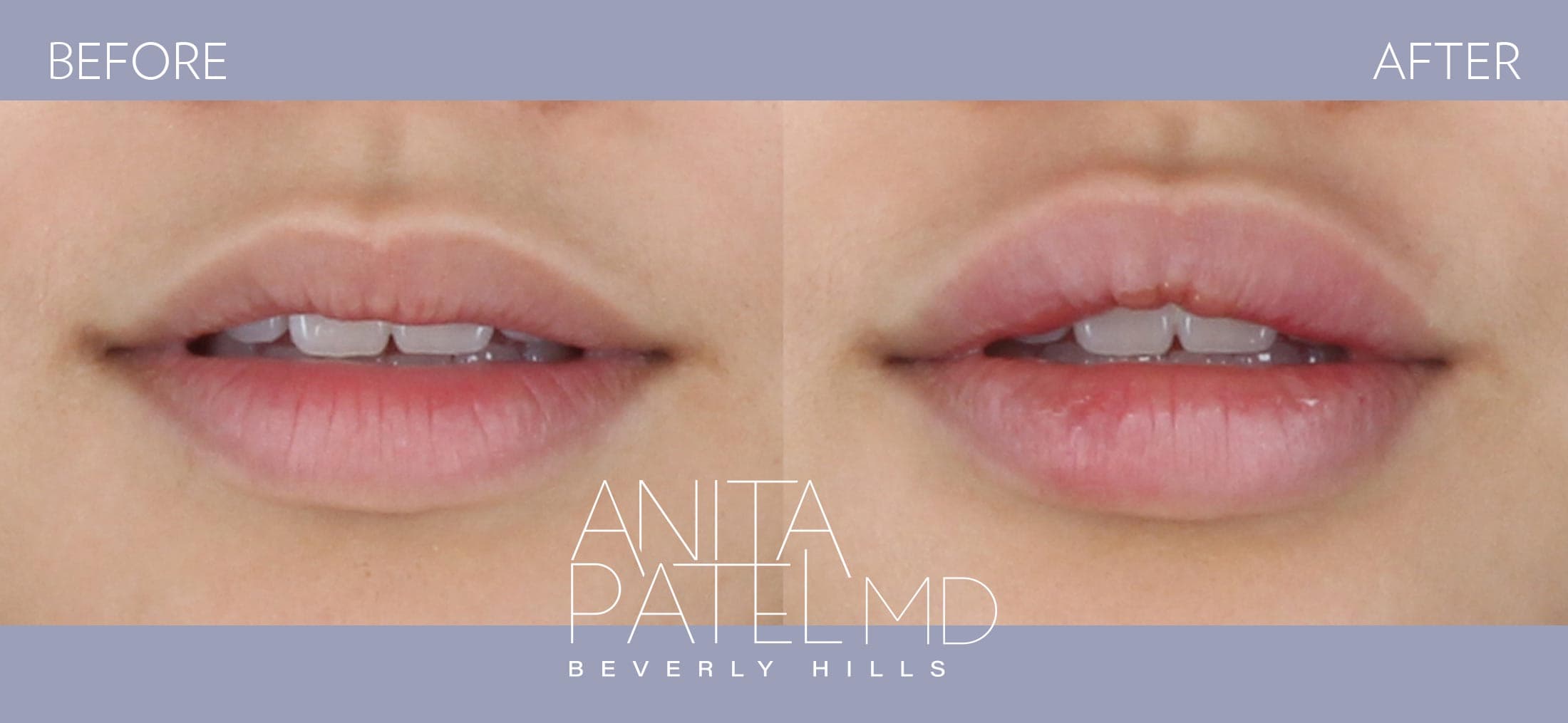Lip Fillers before and after — Patient 4, photo 2 of 2 — Dr. Anita Patel, MD, FACS, Beverly Hills