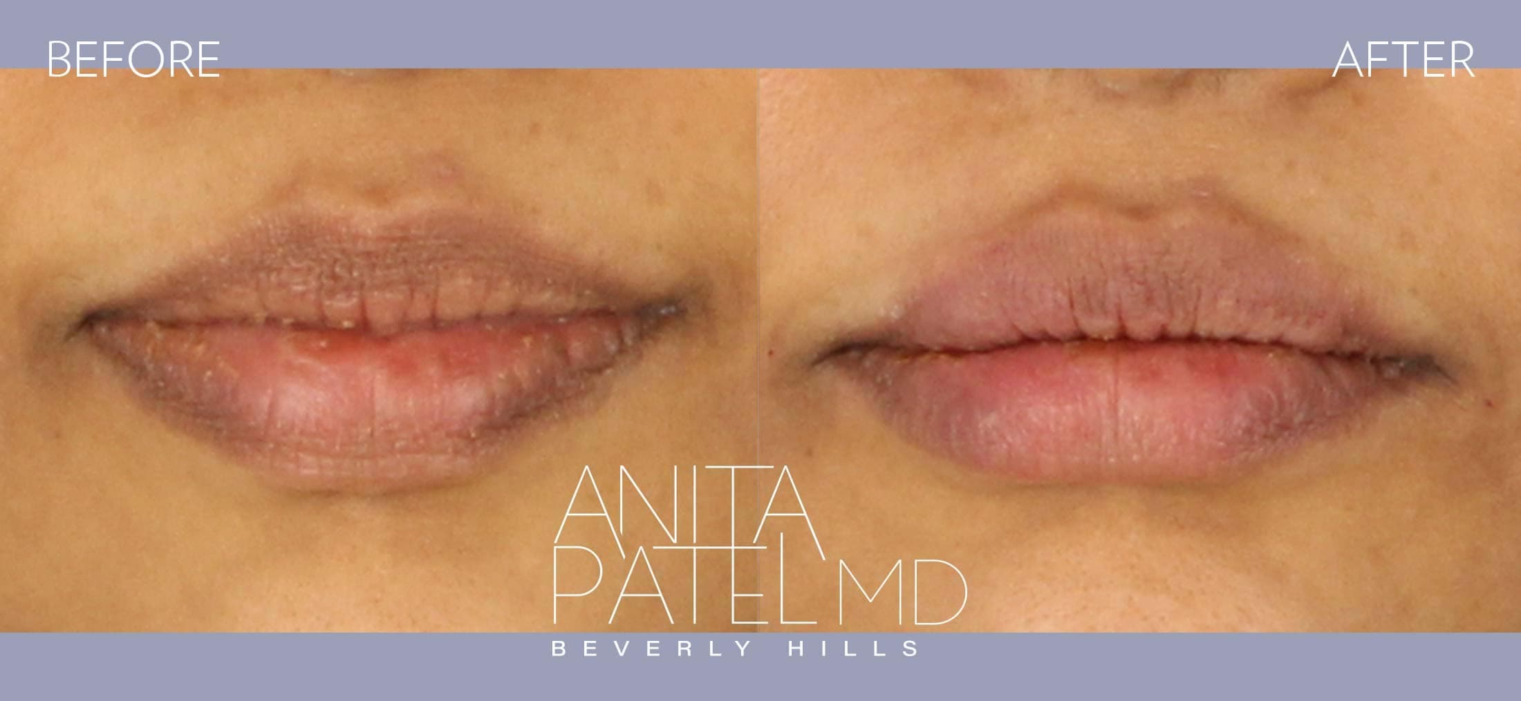 Lip Fillers before and after — Patient 8 — Dr. Anita Patel, MD, FACS, Beverly Hills