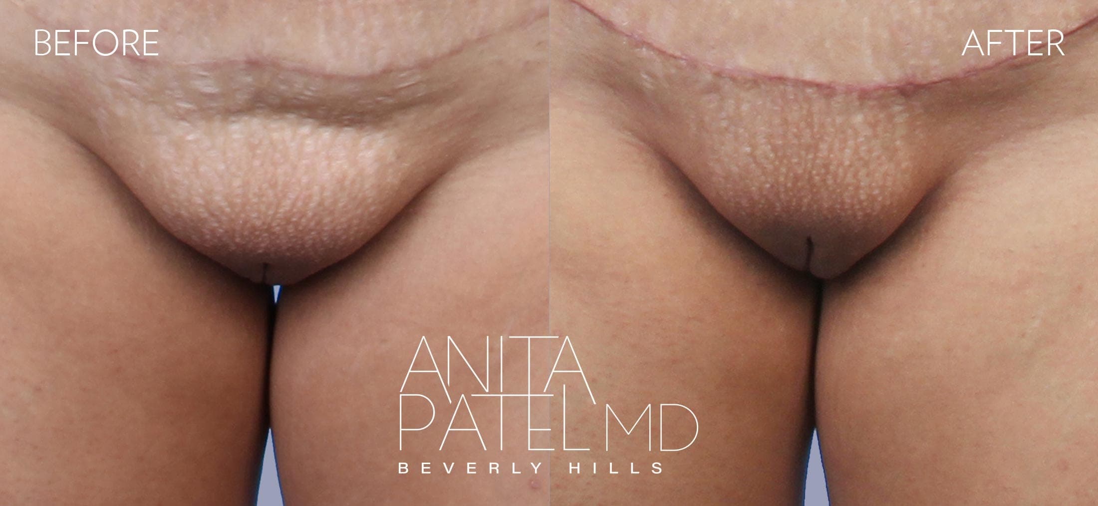Mons Pubis Reduction before and after — Patient 2 — Dr. Anita Patel, MD, FACS, Beverly Hills