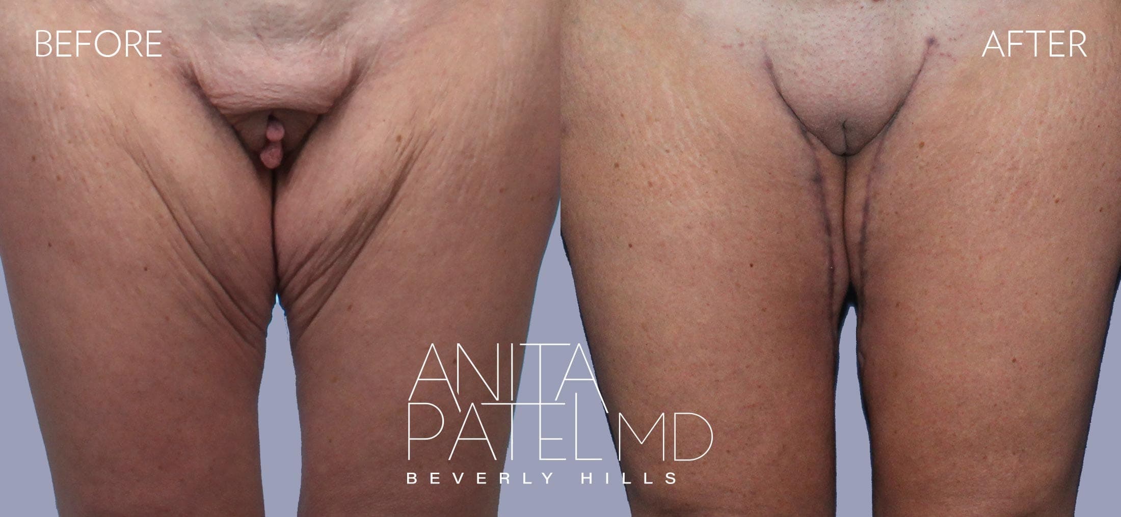 Mons Pubis Reduction before and after — Patient 3 — Dr. Anita Patel, MD, FACS, Beverly Hills