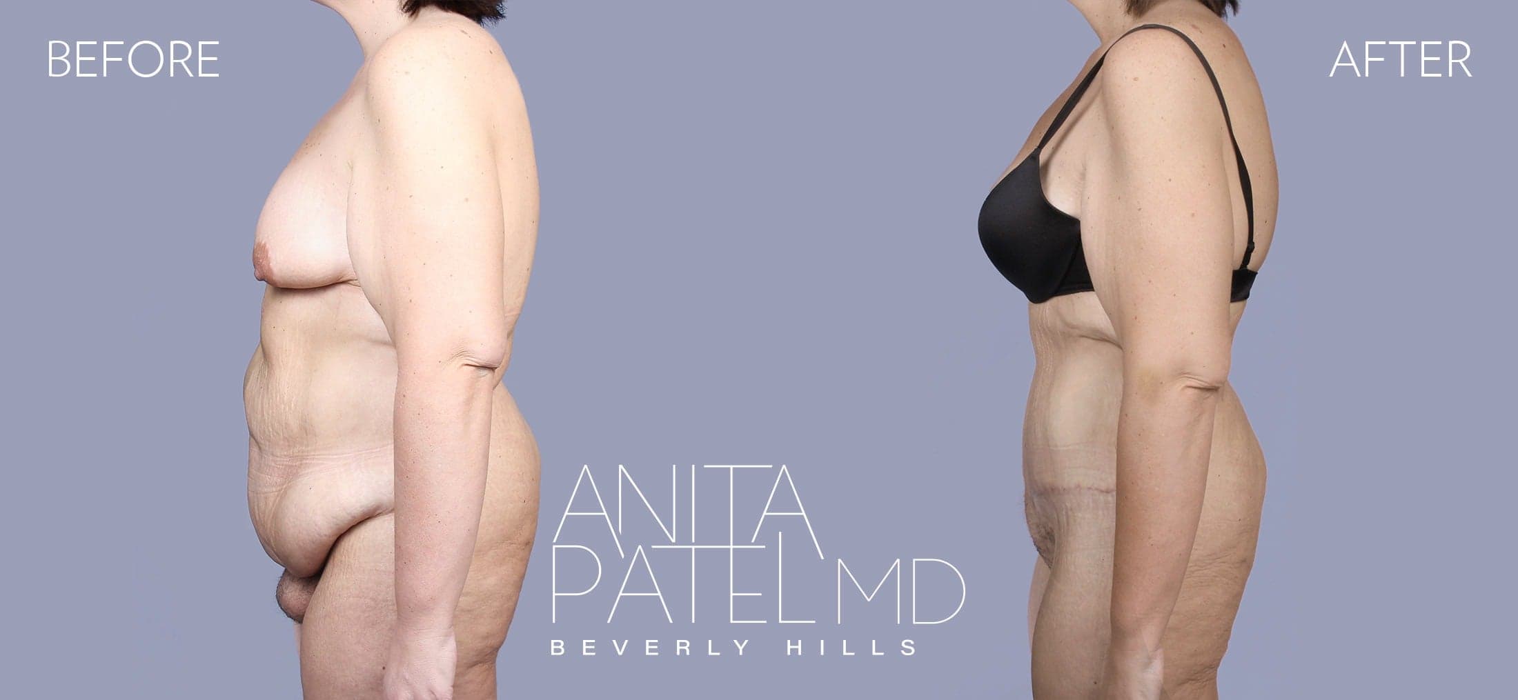 Mons Pubis Reduction before and after — Patient 1, photo 1 of 3 — Dr. Anita Patel, MD, FACS, Beverly Hills