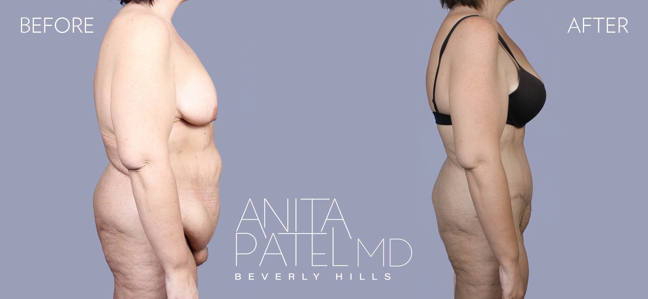 Mons Pubis Reduction before and after — Patient 1, photo 2 of 3 — Dr. Anita Patel, MD, FACS, Beverly Hills