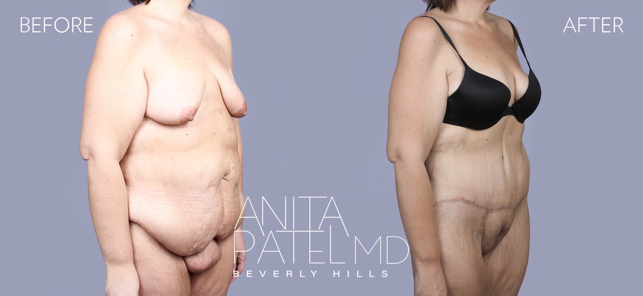 Mons Pubis Reduction before and after — Patient 1, photo 3 of 3 — Dr. Anita Patel, MD, FACS, Beverly Hills