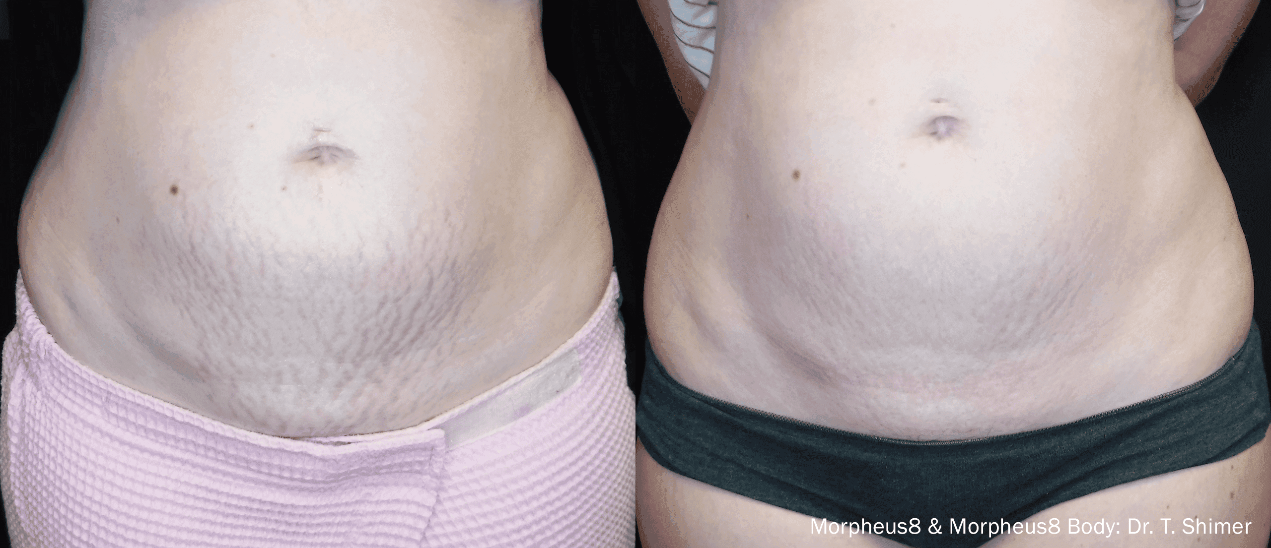 Morpheus8 RF Microneedling before and after — Dr. Anita Patel, Beverly Hills