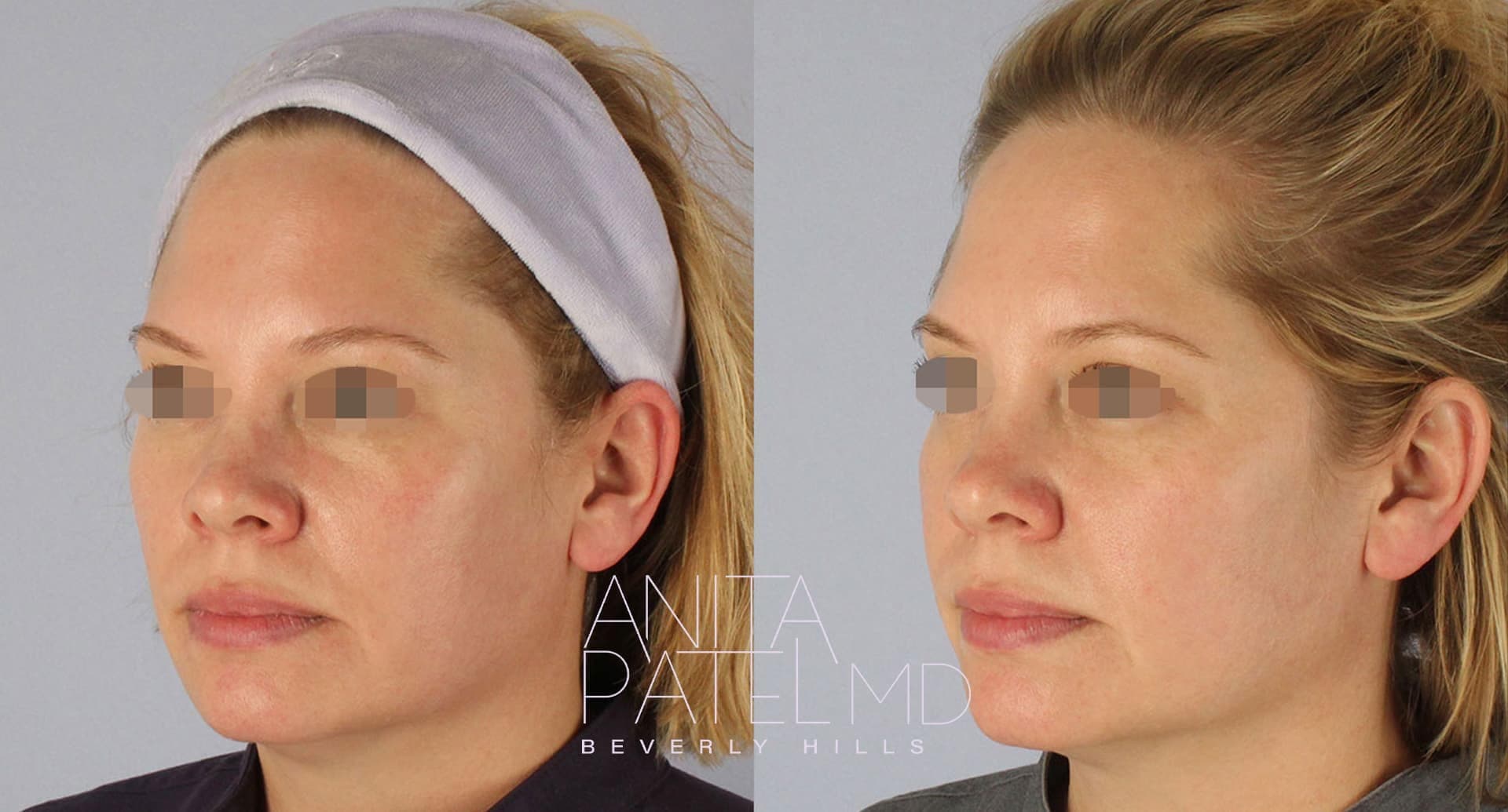 Morpheus8 RF Microneedling before and after — Patient 9 — Dr. Anita Patel, MD, FACS, Beverly Hills