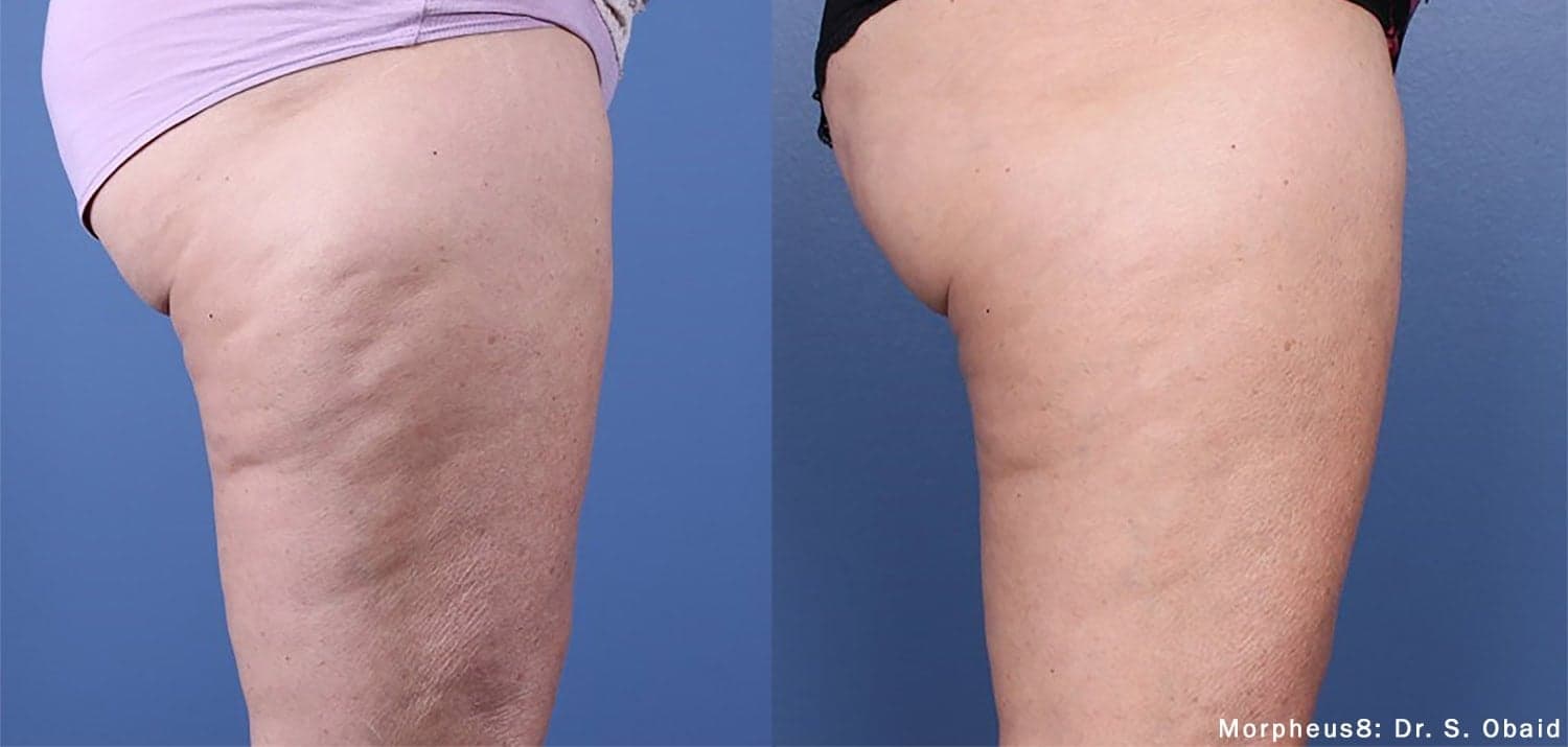 Morpheus8 RF Microneedling before and after — Patient 15 — Dr. Anita Patel, MD, FACS, Beverly Hills