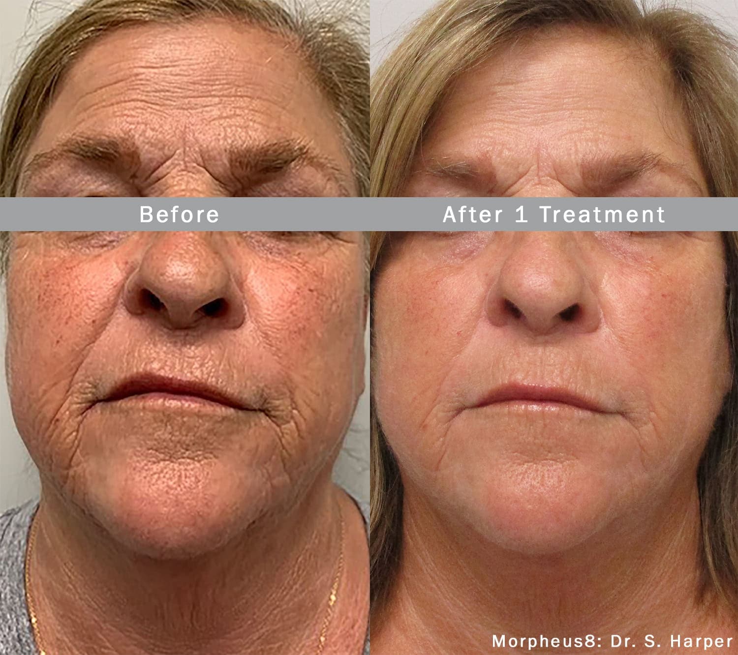 Morpheus8 RF Microneedling before and after — Patient 12 — Dr. Anita Patel, MD, FACS, Beverly Hills