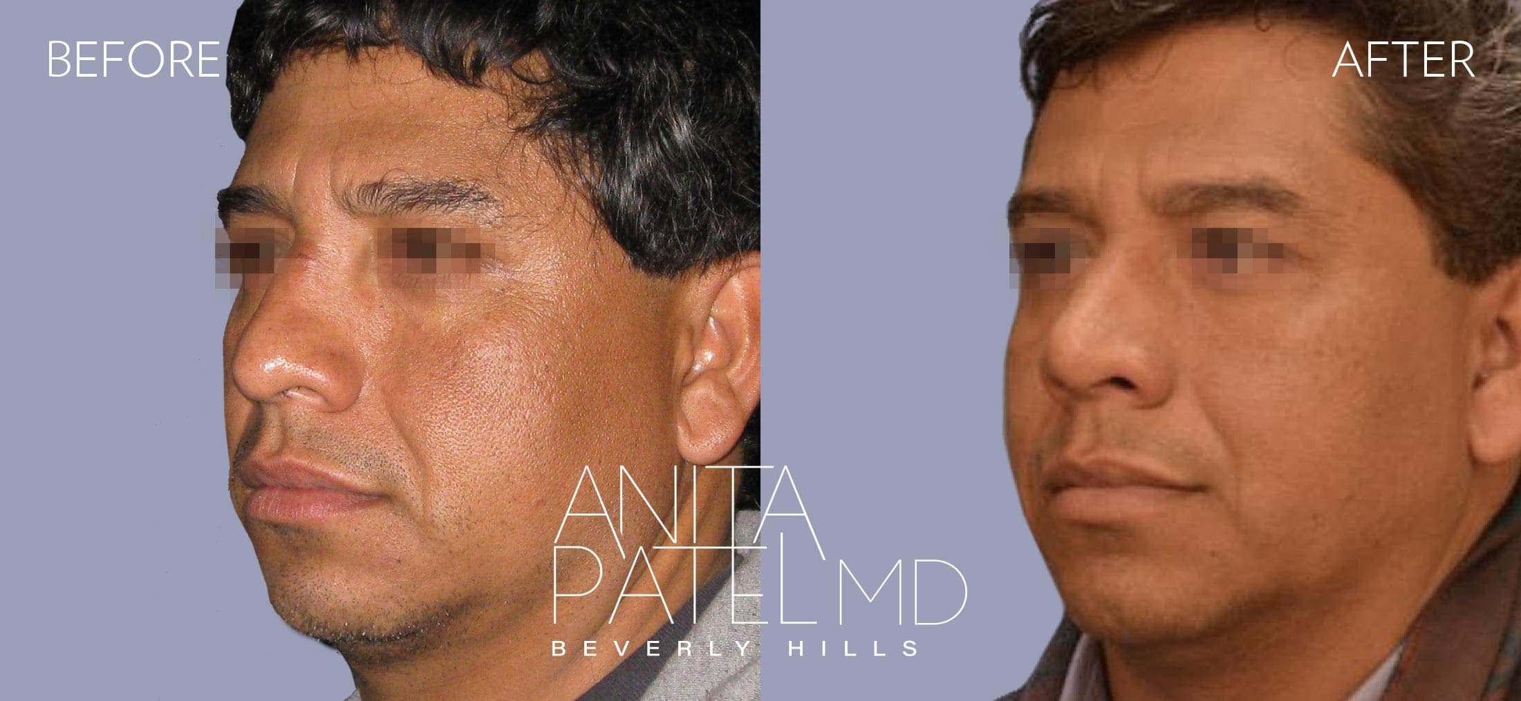 Septoplasty before and after — Patient 1, photo 2 of 3 — Dr. Anita Patel, MD, FACS, Beverly Hills