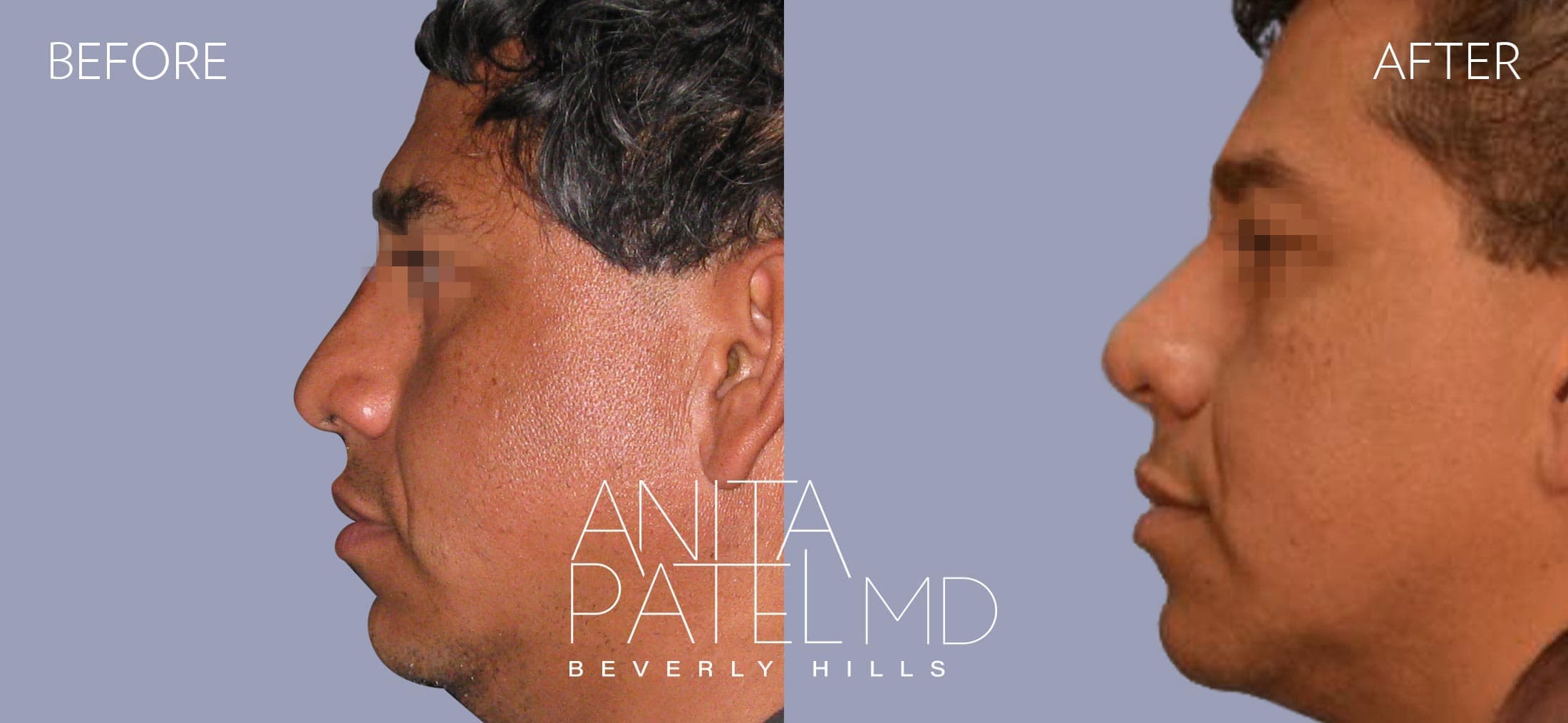 Septoplasty before and after — Patient 1, photo 3 of 3 — Dr. Anita Patel, MD, FACS, Beverly Hills