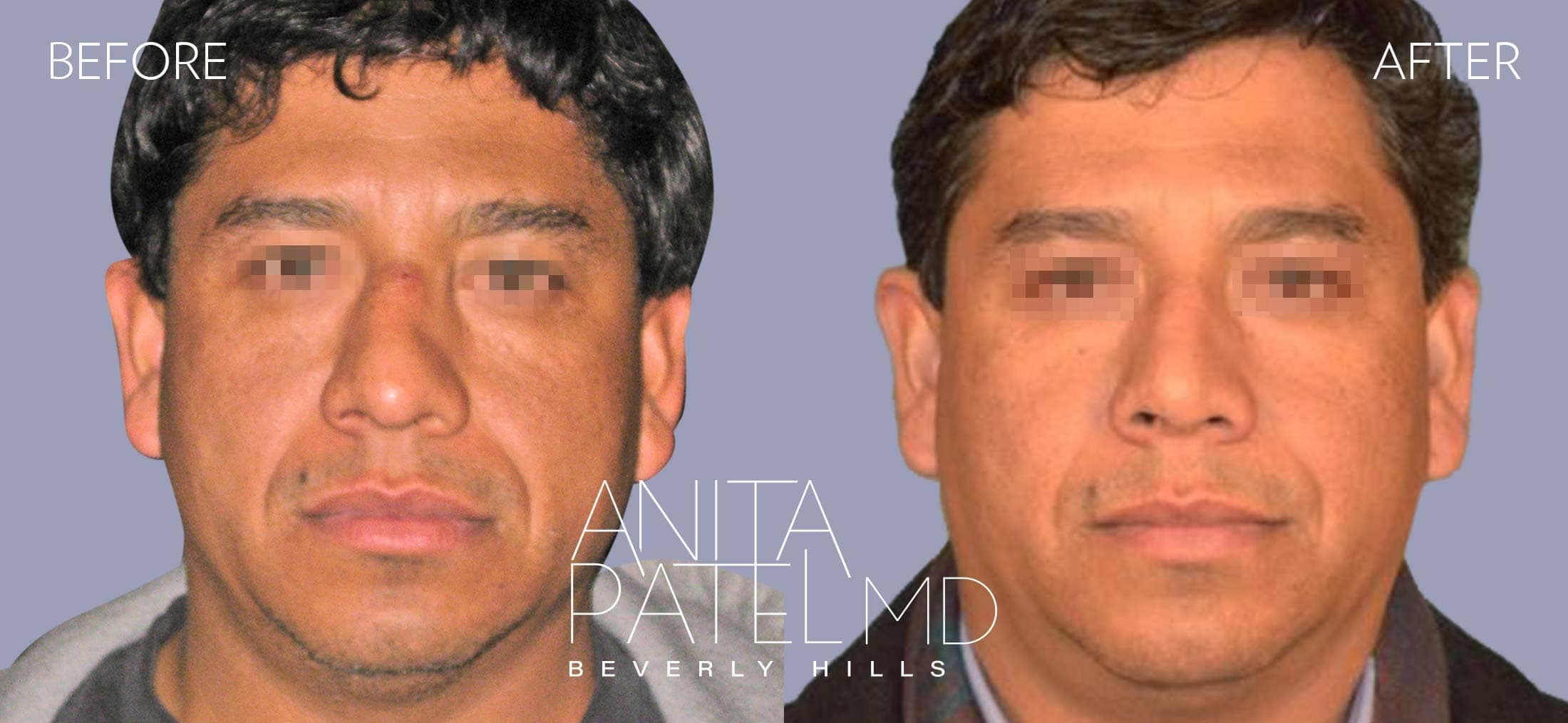 Septoplasty before and after — Dr. Anita Patel, Beverly Hills