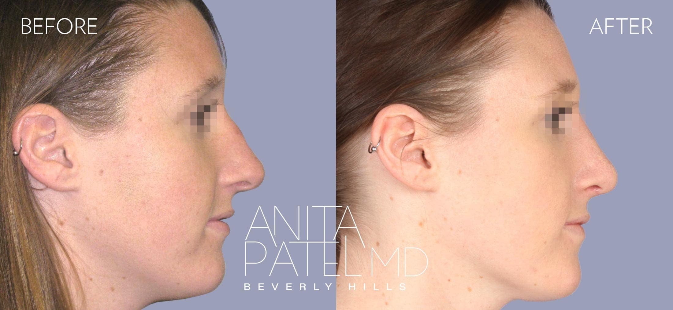 Septoplasty before and after — Patient 2, photo 3 of 3 — Dr. Anita Patel, MD, FACS, Beverly Hills