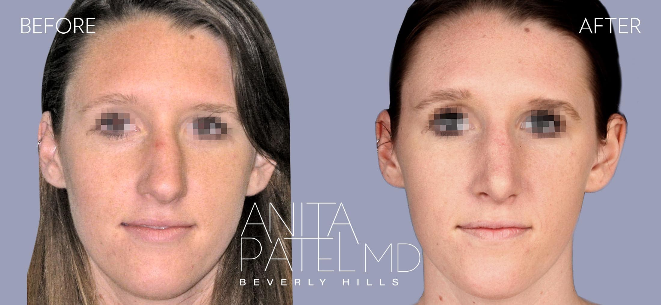 Septoplasty before and after — Patient 2, photo 1 of 3 — Dr. Anita Patel, MD, FACS, Beverly Hills