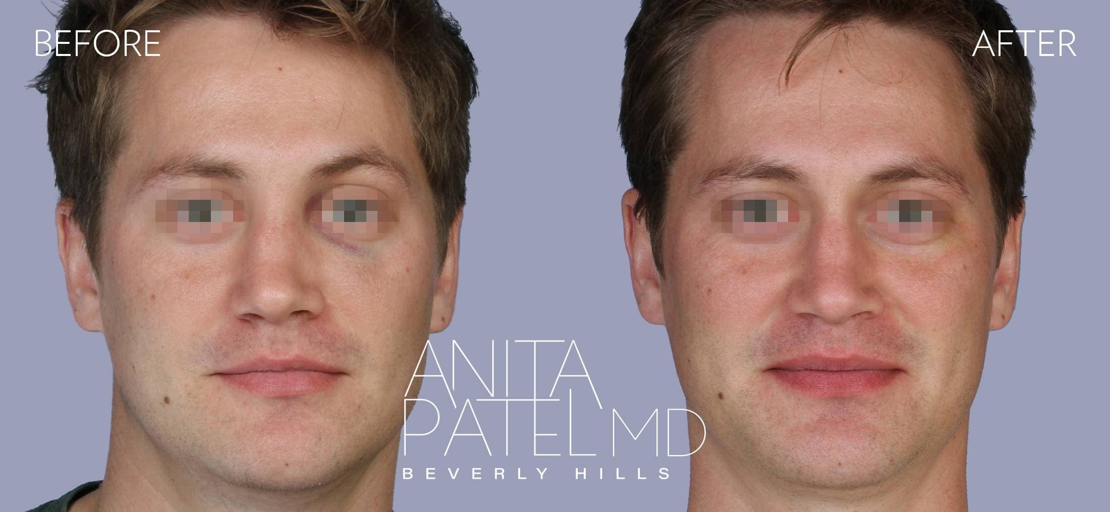 Septoplasty before and after — Patient 3, photo 1 of 4 — Dr. Anita Patel, MD, FACS, Beverly Hills