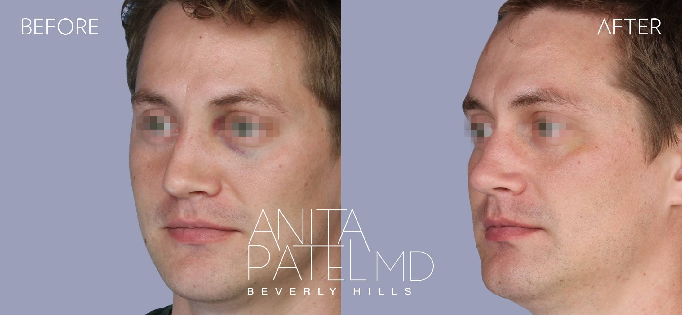 Septoplasty before and after — Patient 3, photo 3 of 4 — Dr. Anita Patel, MD, FACS, Beverly Hills