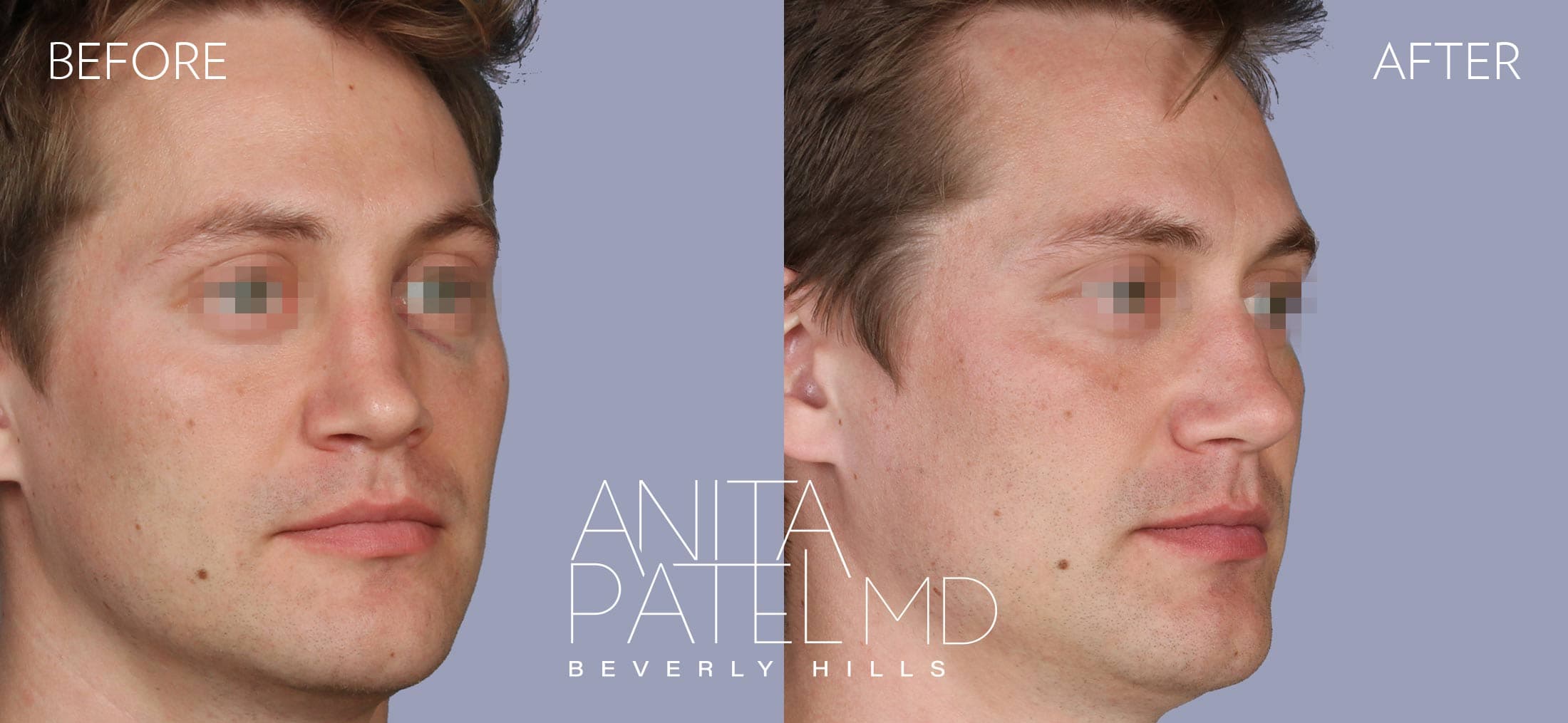 Septoplasty before and after — Patient 3, photo 4 of 4 — Dr. Anita Patel, MD, FACS, Beverly Hills