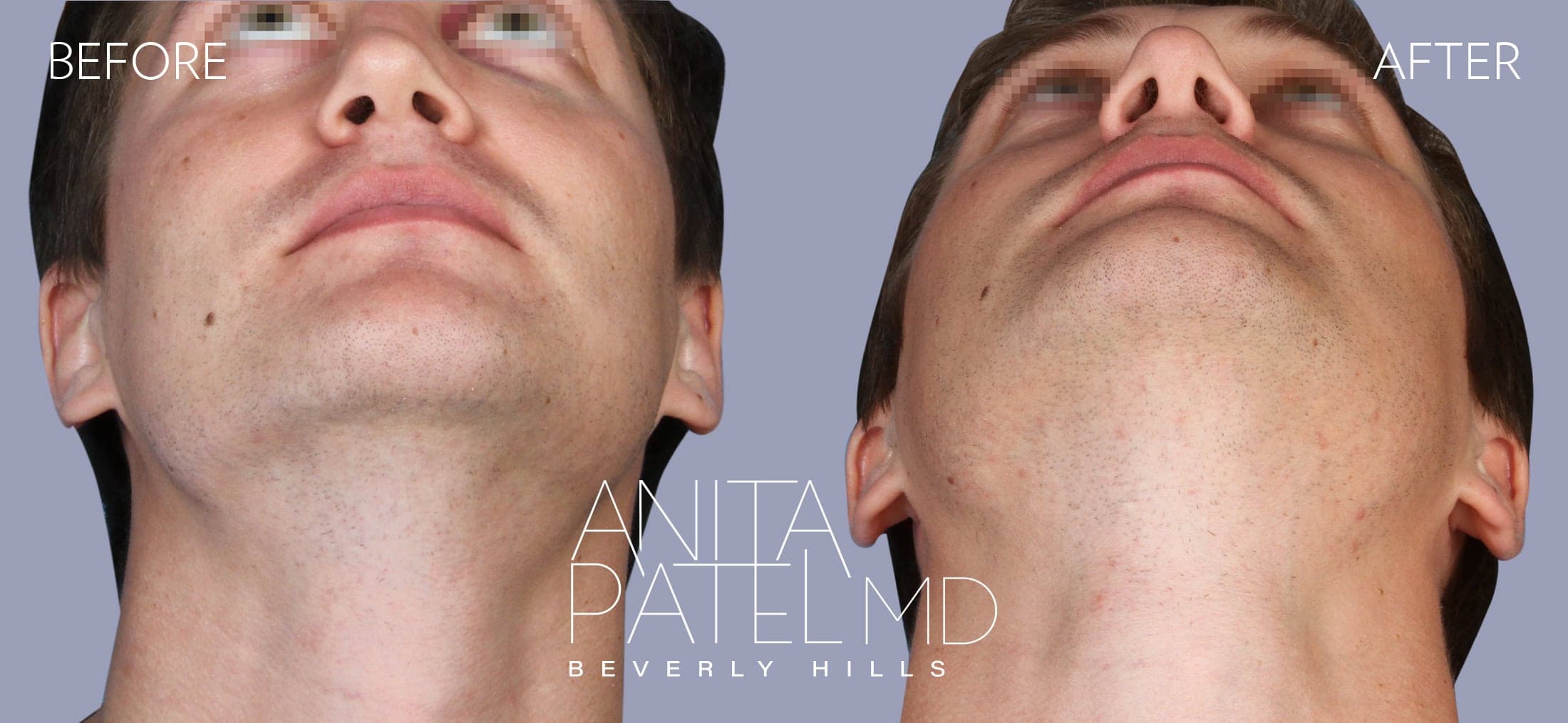 Septoplasty before and after — Patient 3, photo 2 of 4 — Dr. Anita Patel, MD, FACS, Beverly Hills